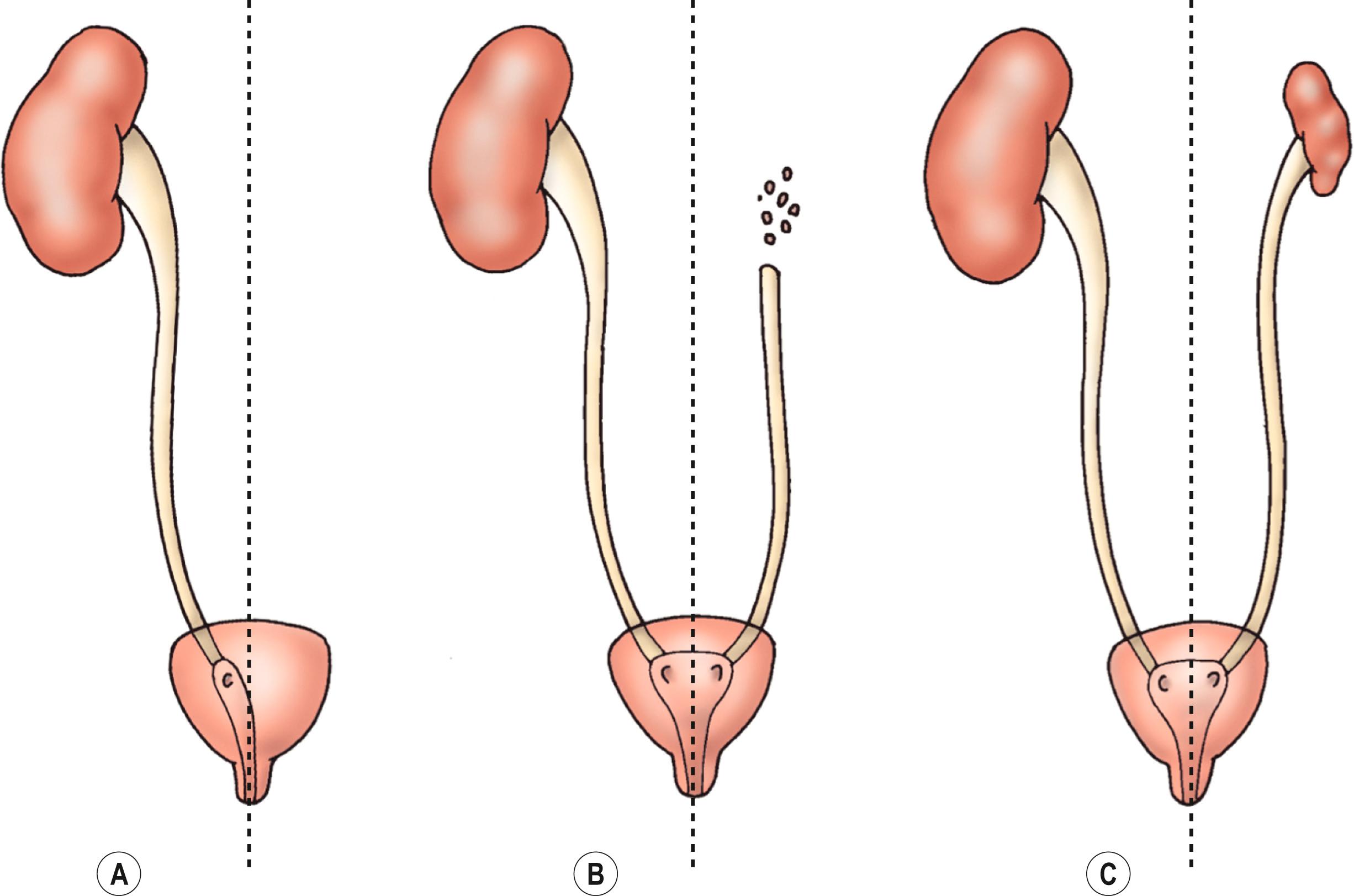 Fig. 53.3, Renal (A) agenesis, (B) dysplasia, and (C) hypoplasia.