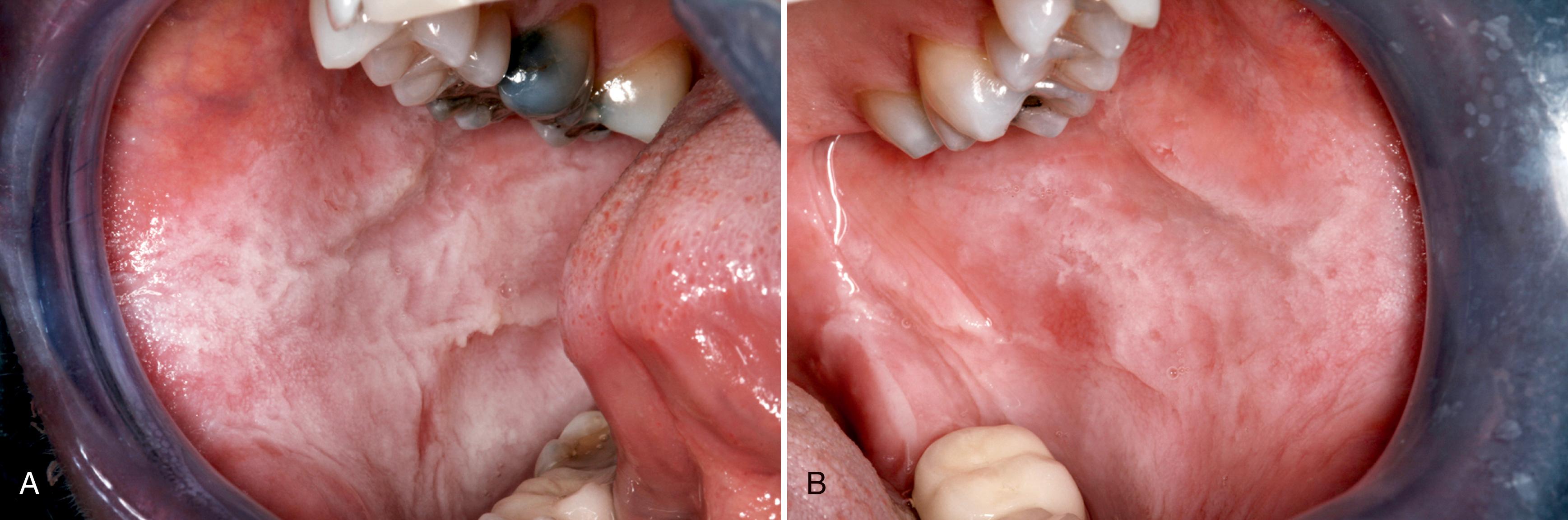 FIG. 2.1, (A) and (B) White sponge nevus: diffuse, boggy white plaques of the buccal mucosa present bilaterally.