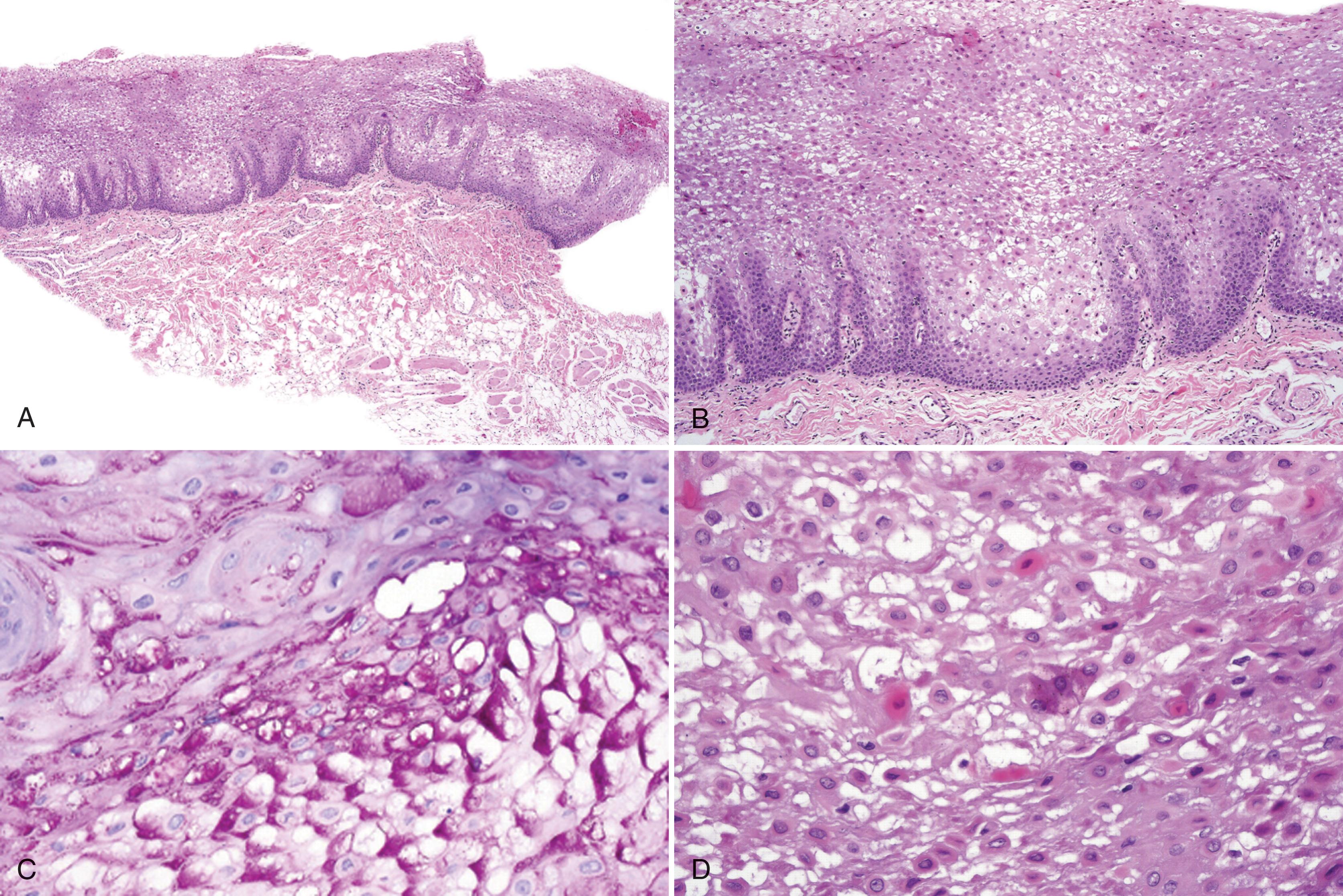 FIG. 2.2, White sponge nevus. (A) The epithelium exhibits acanthosis with a pale “spongy” appearance. (B) The pale epithelium is caused by intracellular vacuolation and dyskeratosis that spares the basal cells. (C) There is positive periodic acid–Schiff staining of intracytoplasmic granules typical for glycogen. (D) There are perinuclear eosinophilic condensations and intracytoplasmic vacuolation (not spongiosis).