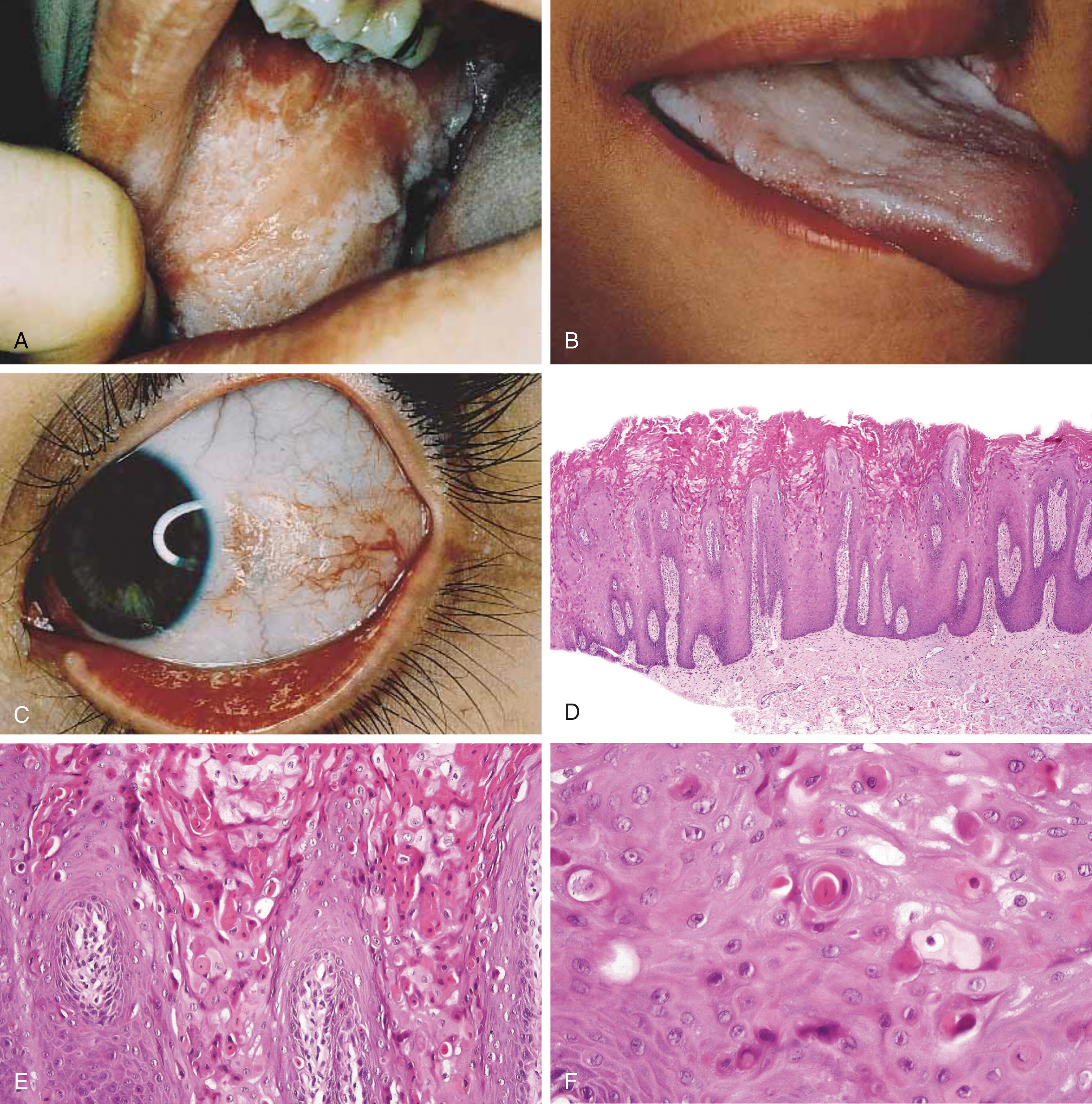 FIG. 2.3, Hereditary benign intraepithelial dyskeratosis. (A) and (B) Dense white plaques of the buccal mucosa and tongue. (C) Gelatinous plaque of the lateral bulbar conjunctiva. (D) Parakeratosis and acanthosis with dyskeratosis. (E) Prominent dyskeratosis within the superficial keratinocytes. (F) Dyskeratotic cells with “cell-within-a-cell” morphology.