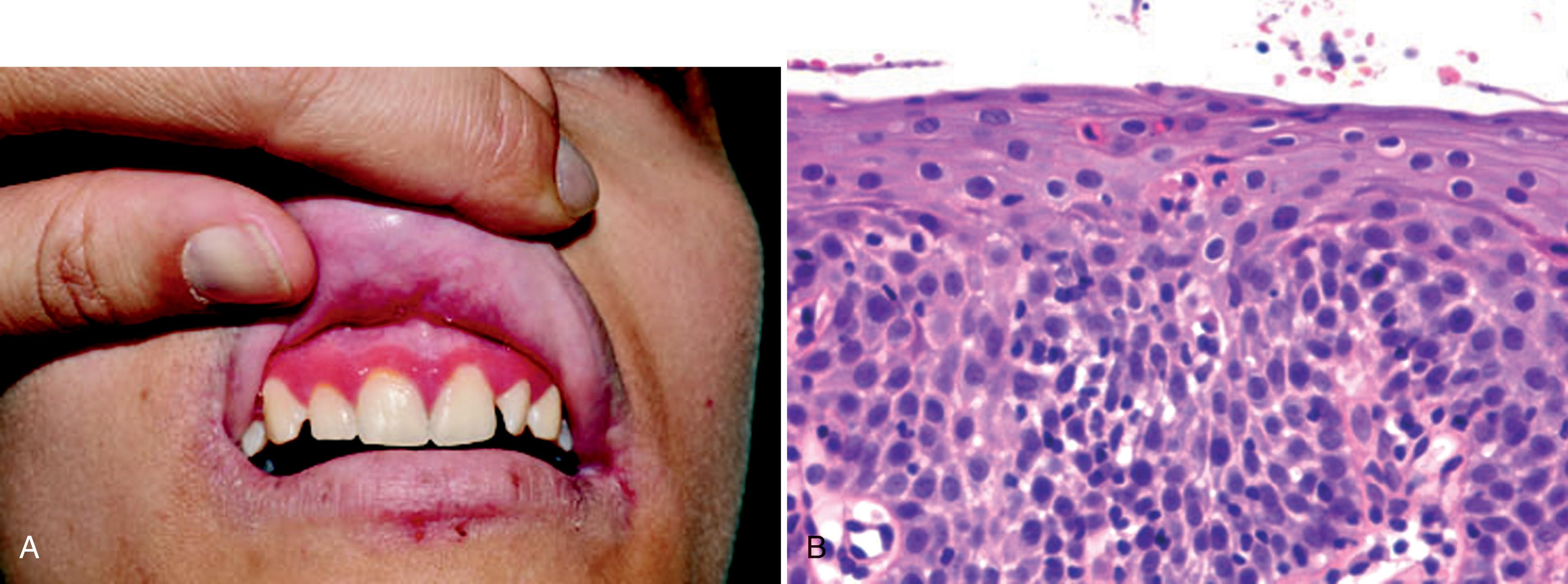 FIG. 2.5, Hereditary mucoepithelial dysplasia. (A) Demarcated erythema of the gingiva. (B) Gingival tissue biopsy sample showing scattered dyskeratotic keratinocytes and spongiosis.