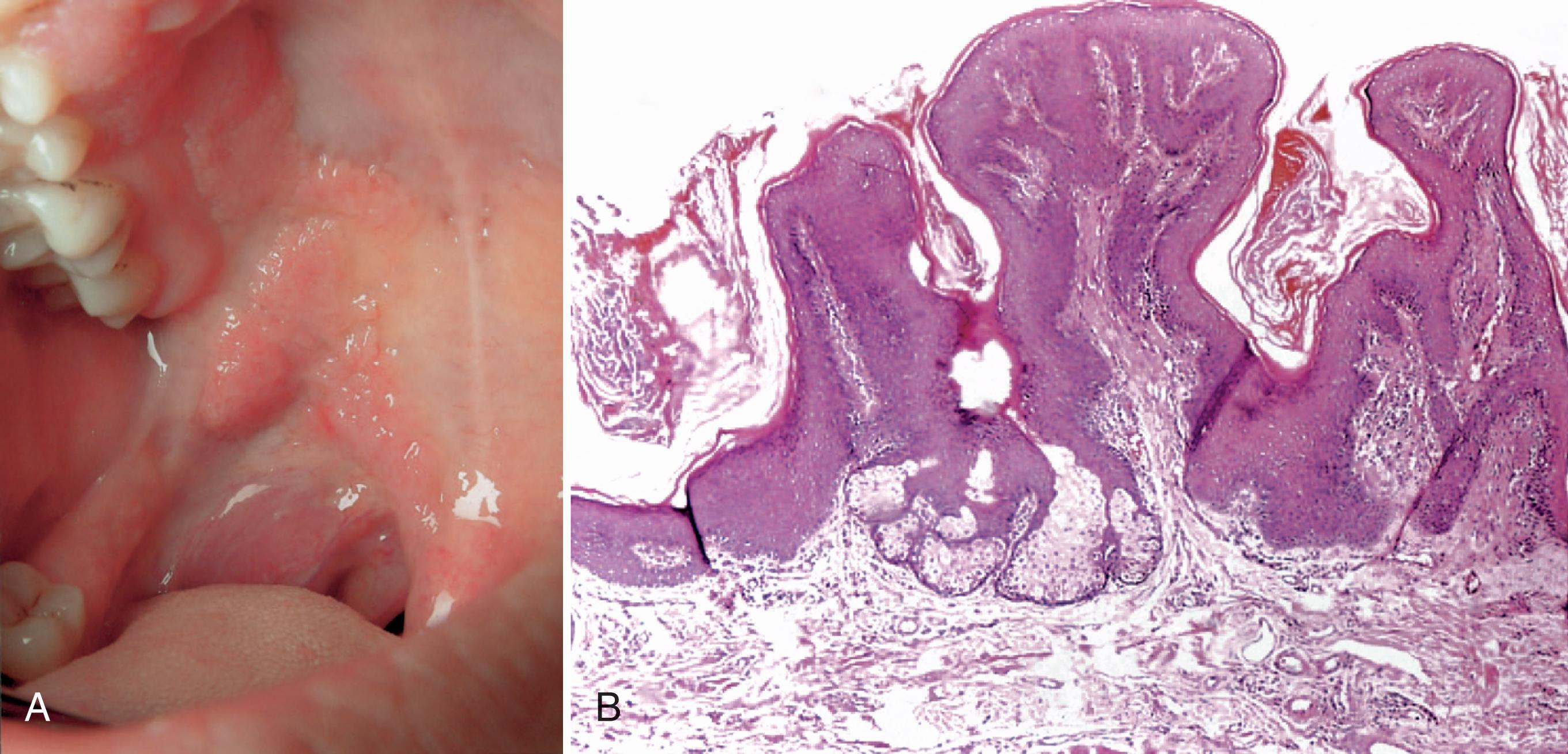 FIG. 2.6, Oral linear epidermal nevus. (A) Palatal mucosa with linear verrucous mucosal plaque ipsilateral to cutaneous lesion. (B) Oral mucosa exhibiting hyperkeratosis, papillary acanthosis, and sebaceous glands.