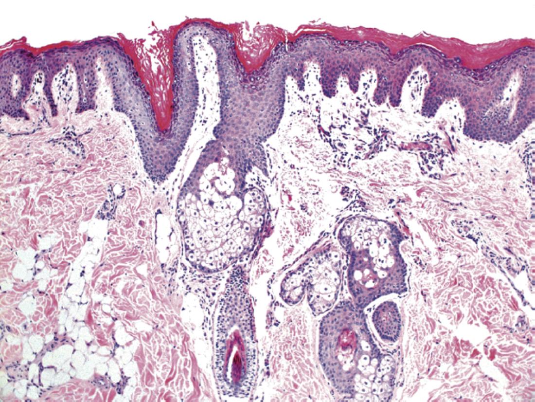 FIG. 2.7, Oral epidermal choristomas composed of epidermis and underlying pilosebaceous glands.