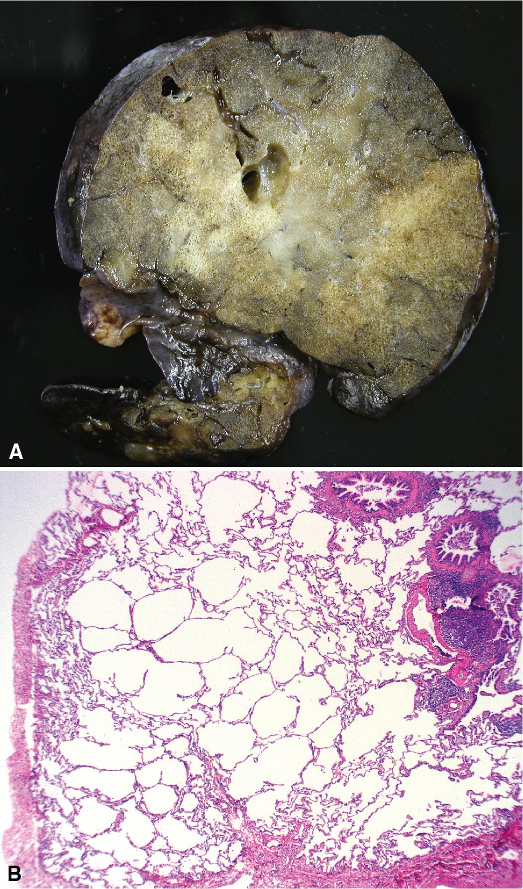 Figure 5.11, Congenital lobar overinflation. (A) The major portion of a lobe in this specimen is massively overinflated, typically as a result of progressive air-trapping by bronchial stenosis or bronchomalacia, resulting in a region of pallor and accentuated air spaces. This specimen also shows focal pulmonary interstitial emphysema due to air leakage. (B) Microscopically, the overinflated alveoli are enlarged and distended but typically show normal development.