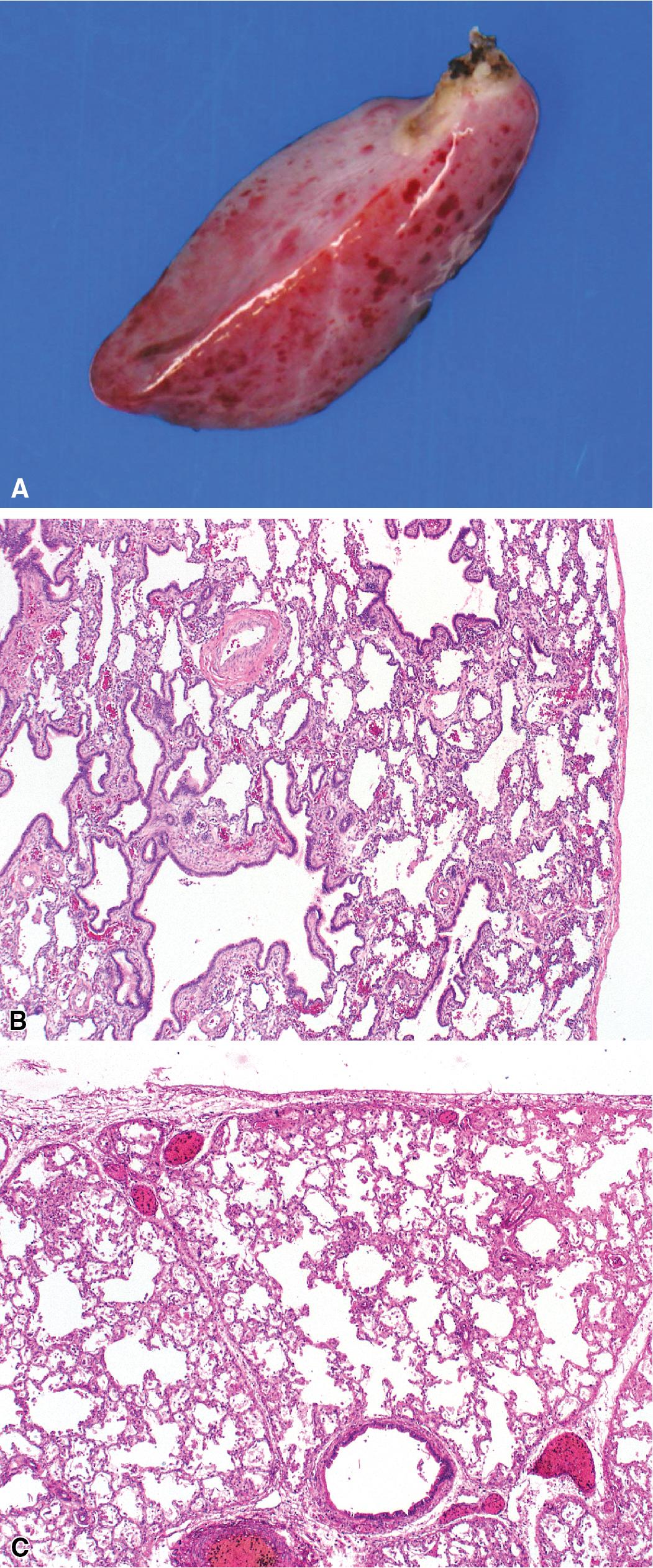 Figure 5.3, Extralobar sequestration. Extralobar sequestrations are often small pyramidal “accessory lobes” with a vascular pole on one side (A). They can have various histologic appearances, most often resembling the type 2 (small cyst) congenital pulmonary airway malformation pattern (B), and occasionally showing near-normal lung parenchyma with only mildly enlarged air spaces (C).