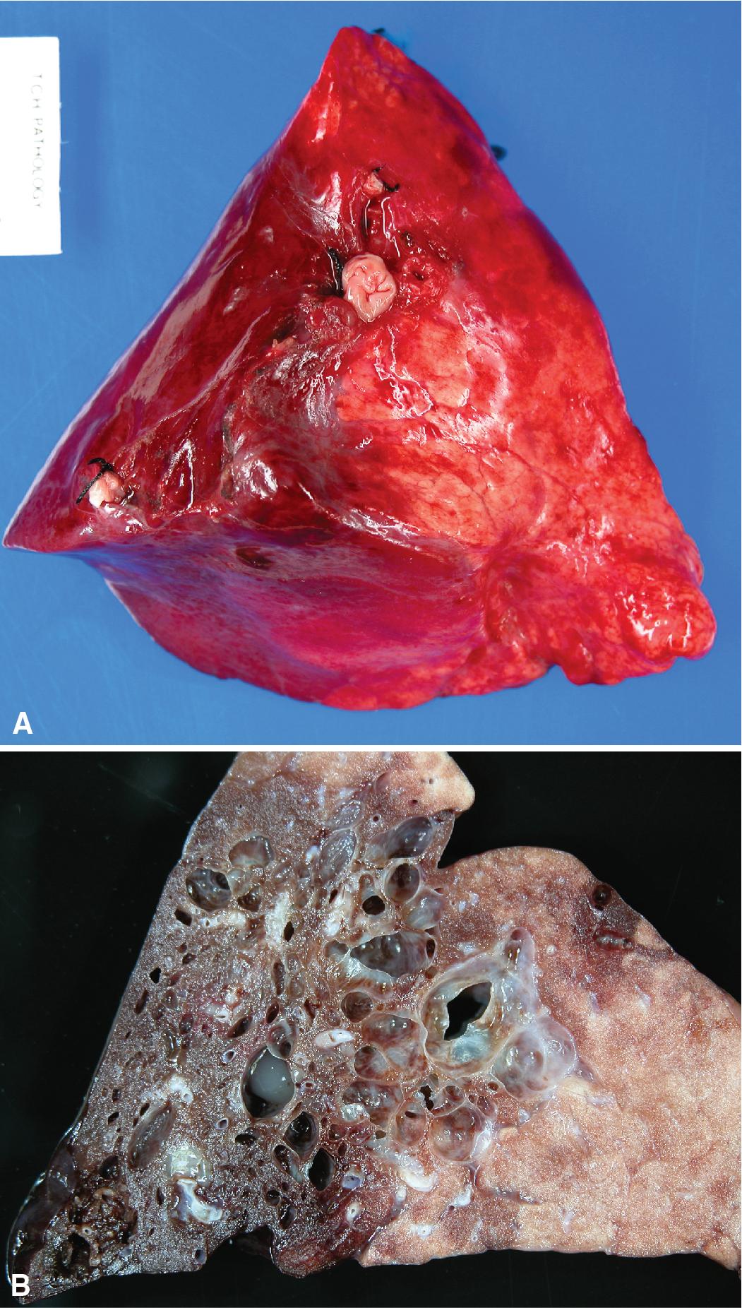 Figure 5.4, Intralobar sequestration. The sequestered lung is marked on the pleural surface by a region of congestion and hemorrhage. (A) An elastic artery of systemic origin is typically present on the inferomedial aspect of the lower lobe. (B) The cut surface is similarly congested and also demonstrates cystic change and mucus stasis, as seen in isolated segmental bronchial atresia.