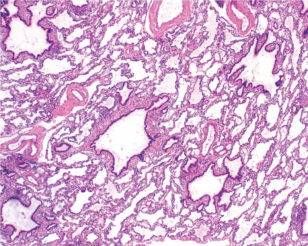 Figure 5.7, Congenital pulmonary airway malformation. This type 2 congenital pulmonary airway malformation shows numerous dilated bronchiolar structures within a background of enlarged irregular alveolar structures. This pattern is associated with intrauterine bronchial obstruction, for example bronchial atresia, intralobar sequestration, and extralobar sequestration.