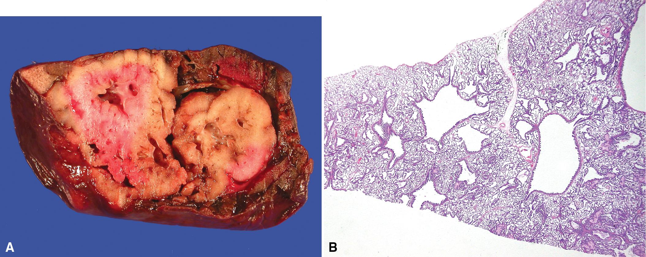 Figure 5.8, Congenital pulmonary airway malformation. (A) Grossly, this congenital pulmonary airway malformation shows a spongy mass of abnormal tissue replacing the lobe. (B) The abnormally developed parenchyma shows dilated bronchiolar structures surrounded by elongated hyperplastic air spaces.