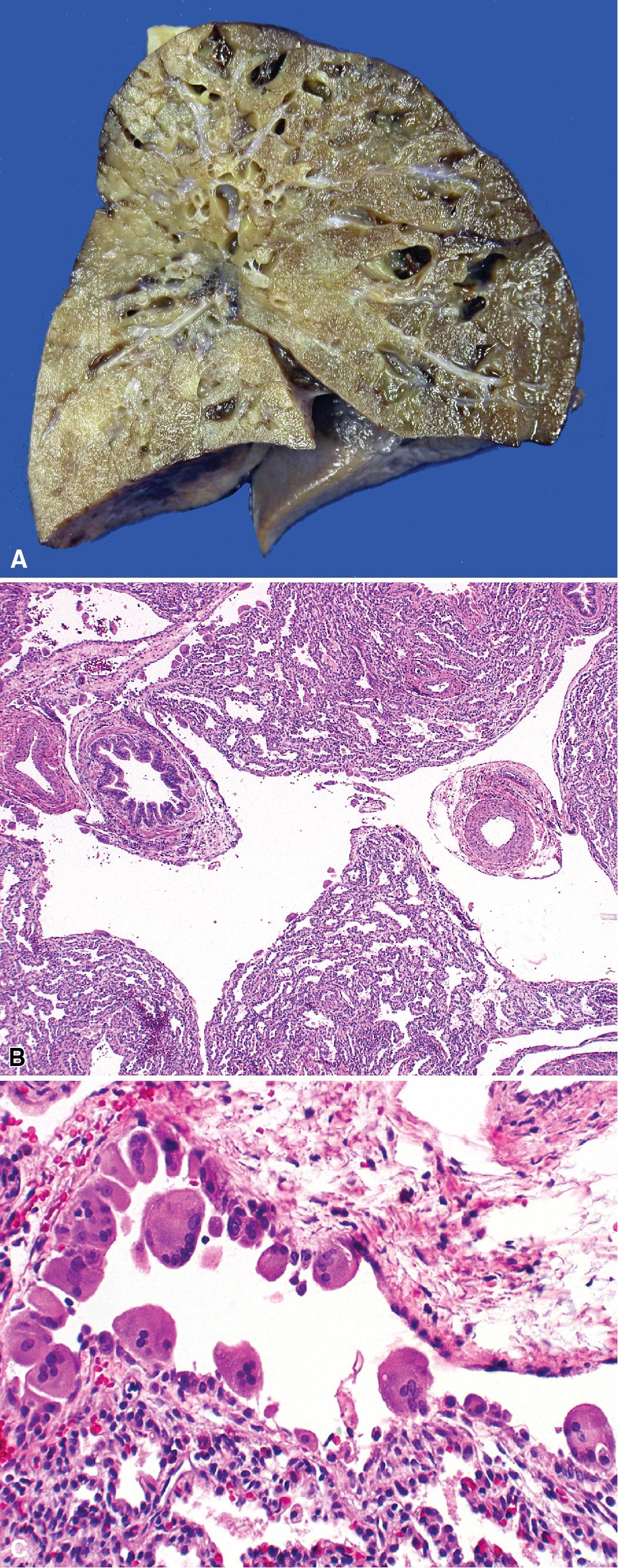 Figure 5.9, Pulmonary interstitial emphysema (PIE). PIE is caused by air leakage from ruptured alveoli, with dissection of air into the interstitium along bronchovascular bundles and interlobular septa, producing angular elongated cysts, seen grossly (A) and microscopically (B). (C) Multinucleate giant cells line the cysts in persistent PIE.