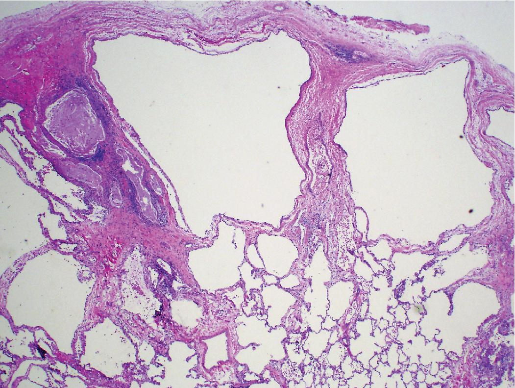 Figure 5.10, Down syndrome: pulmonary involvement. Peripheral cysts and alveolar simplification are prominent features in some children with Down syndrome.