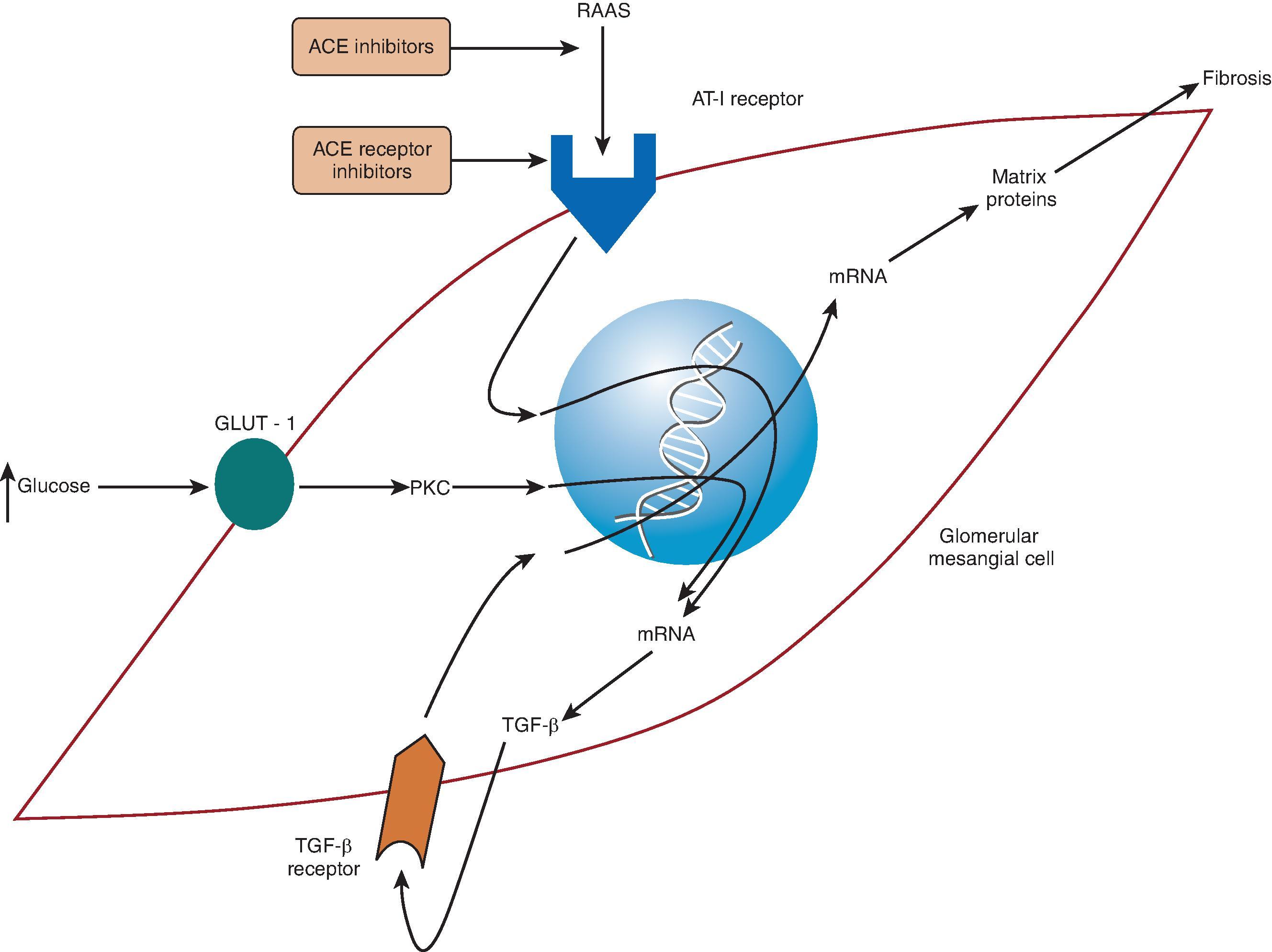 Fig. 50.5, Schematic representation of a glomerular mesangial cell in chronic kidney disease due to diabetic nephropathy. Activation of renin-angiotensin-aldosterone system upregulates TGF-β, which leads to matrix accumulation, inflammation, and fibrosis. Hyperglycemia also perpetuates this fibrosis via increased activity of protein kinase C. Through interruption of this cascade, angiotensin-converting enzyme inhibitors and angiotensin receptor blockers are effective treatments, delaying progression of chronic kidney disease in diabetic nephropathy. ACE , Angiotensin-converting enzyme; AT-I , angiotensin I; GLUT-1 , glucose transporter; mRNA , messenger ribonucleic acid; PKC , protein kinase C; RAAS , renin-angiotensin-aldosterone system; TGF -β, transforming growth factor-β.