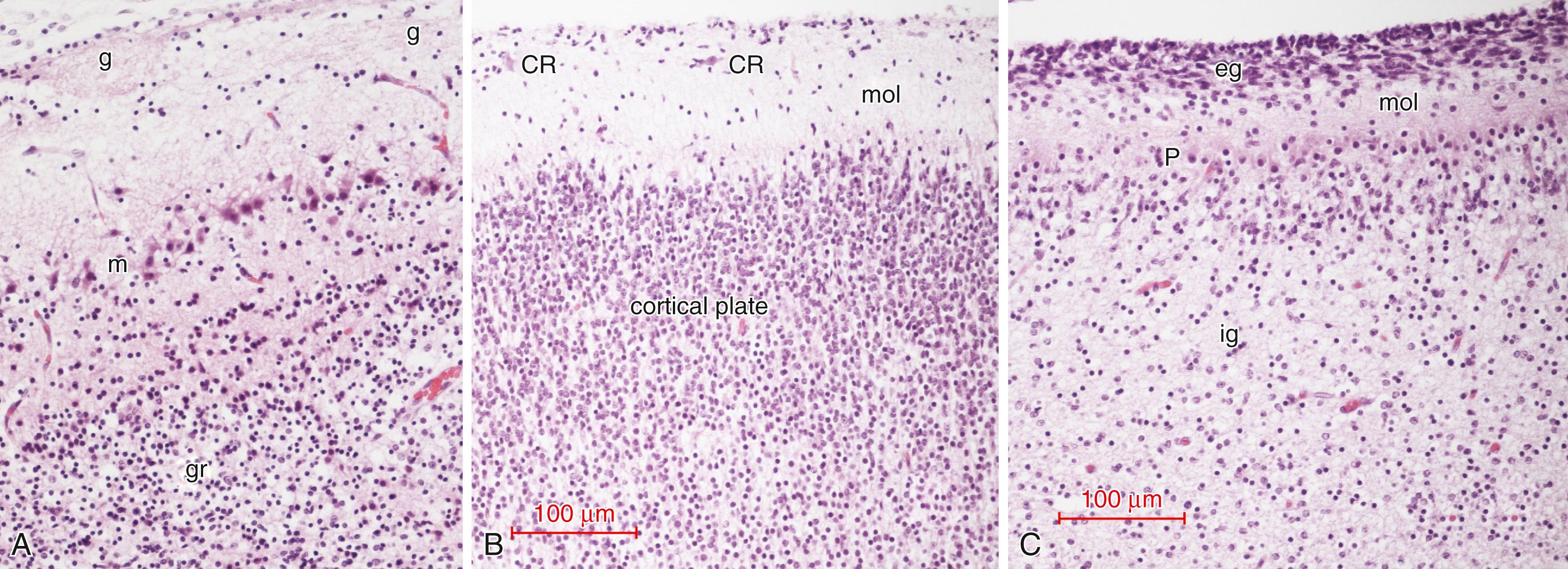 Fig. 136.5, Comparison of the histologic architecture of three laminar cortices of a 21-week human fetus. (A) Olfactory bulb; (B) cerebral neocortex; (C) cerebellar cortex. (A) The surface layers of the olfactory bulb lacks the molecular zone (mol) of the cerebral and cerebellar cortices, the external granular (neuronal) layer (eg) , Purkinje cell layer (P) and internal granular layer (ig) of the cerebellar cortex, and the subpial granular glial layer of Brun of the cerebral cortex. In the olfactory bulb, the layer of fine unmyelinated axons of primary olfactory neurons in the olfactory epithelium coalesce as the superficial layer, corresponding to a compact cranial nerve I. A series of large synaptic glomeruli (g) on the ventral surface of the olfactory bulb is where these primary axons form synapses with dendrites of the single row of mitral neurons (m) , whose somata are deep to the synaptic glomeruli. The synaptic glomeruli correspond to ganglia along the course of other sensory cranial nerves. The deepest layer of the olfactory bulb consists of granular neurons (gr) that lack axons and form dendrodendritic synapses and functionally serve as the principal component of an intrinsic olfactory thalamus, extending into the olfactory tract. None of the axons of the olfactory bulb or tract are myelinated until the postnatal period (not shown).