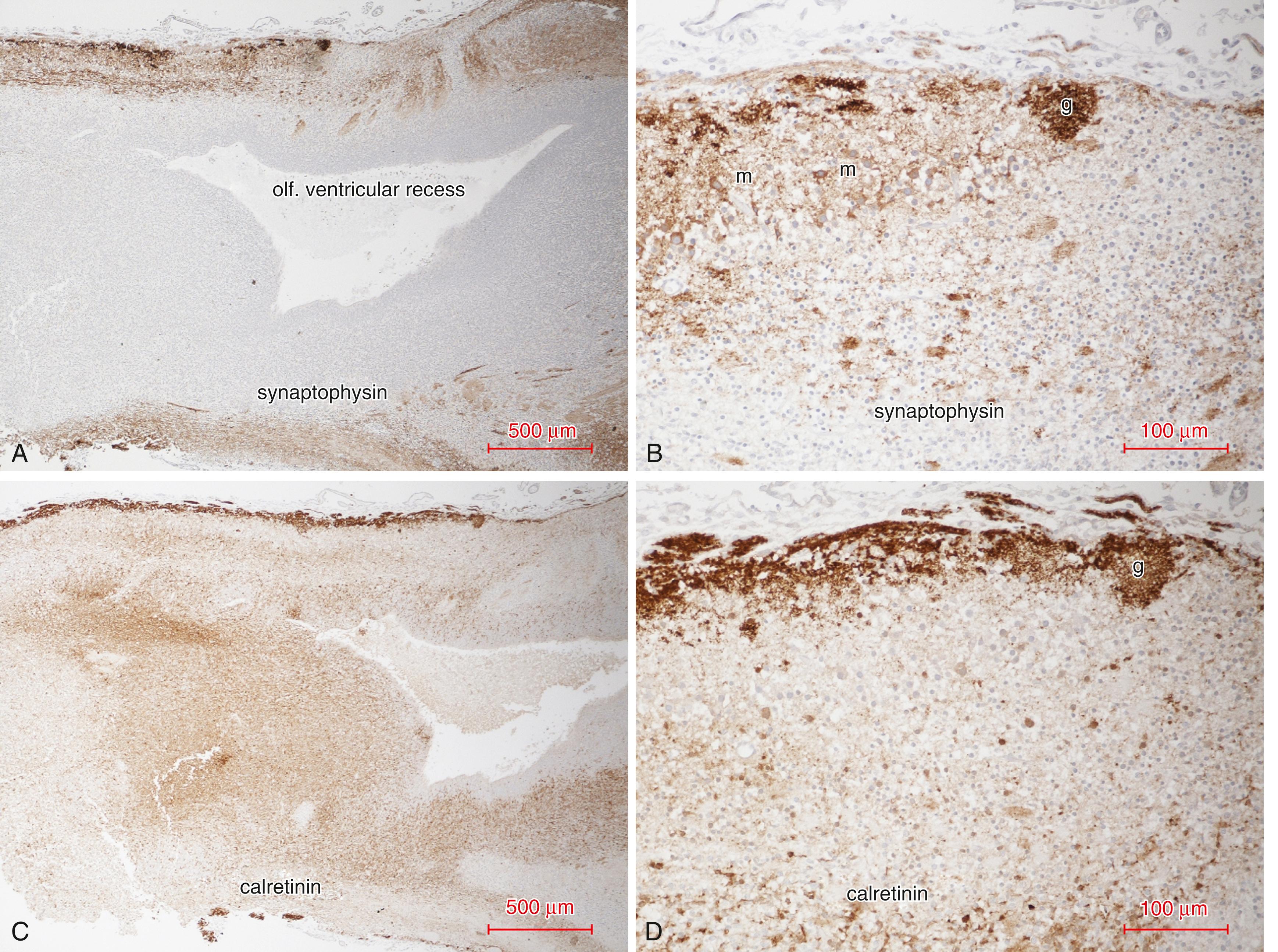 Fig. 136.6, Immunoreactivity demonstrates cytologic maturation of neurons of the olfactory bulb. (A and B) At 16 weeks gestation, there is strong synaptophysin reactivity in the superficial layer of primary olfactory axons; this axoplasmic reactivity is consistent with immaturity. A few synaptic glomeruli (g) are formed. Initiation of synapse formation also is seen in the mitral cell layer (m) and in some synaptic glomeruli. Reactivity is seen within the somatic cytoplasm of immature mitral cells. There is no synaptophysin reactivity in the immature granular layer surrounding the olfactory ventricular recess and in the deep core of the bulb. (C and D) Calretinin immunoreactivity (which selectively demonstrates gamma-aminobutyric acid (GABA)-ergic interneurons) of sections from the same blocks as (A and B) shows a striking contrast to synaptophysin by its strong reactivity in immature granular neurons of the core. Calretinin also is seen in primary olfactory axons in the superficial zone, including some olfactory axons in the meninges that are just entering the olfactory bulb and in some but not all synaptic glomeruli, similar to synaptophysin.