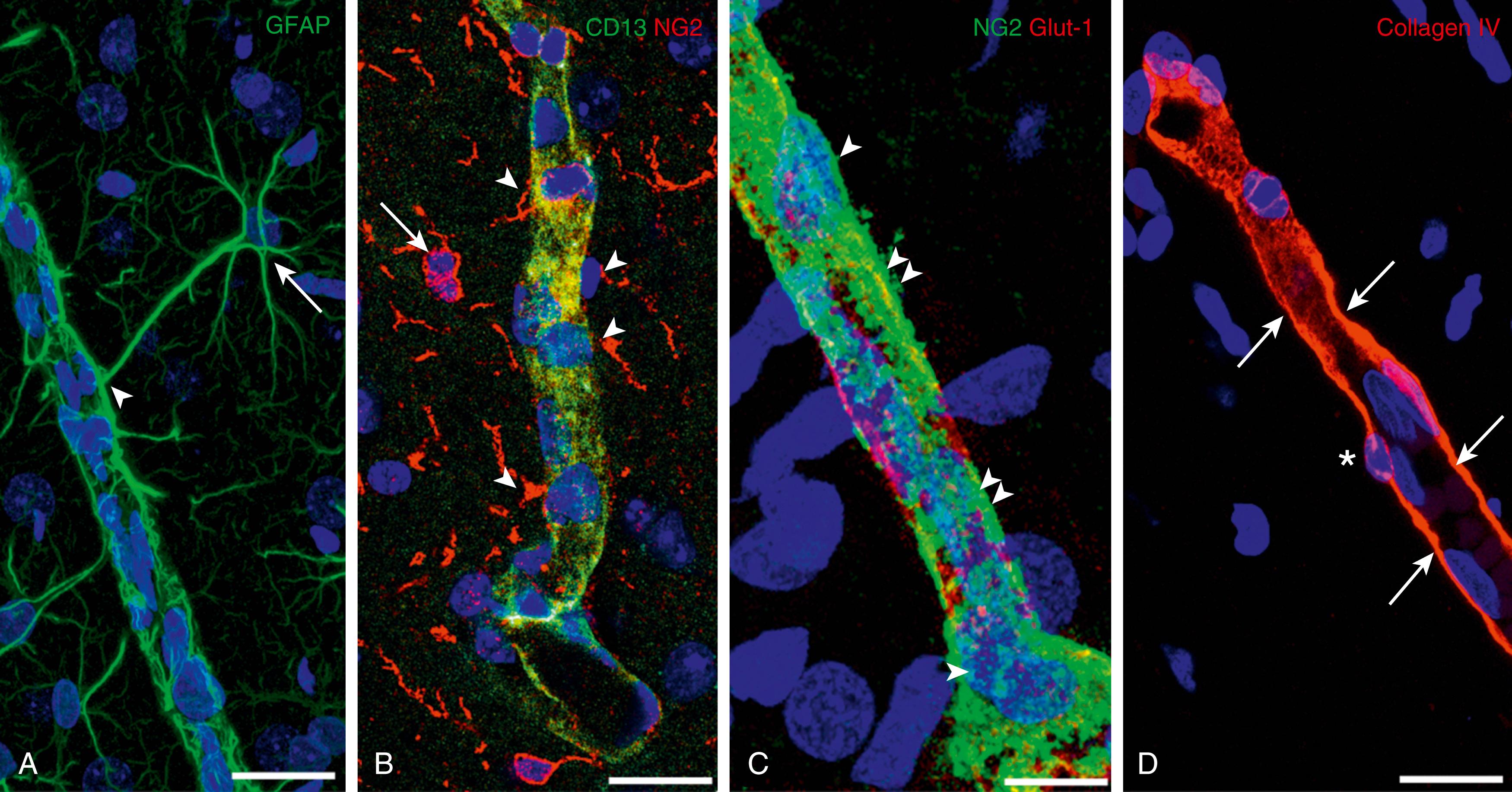 Fig. 126.4, Cellular (A–C) and noncellular (D) components of the neurovascular unit as detected in human fetal telencephalon at 20 weeks of development. (A) A perivascular astrocyte (arrow) is revealed by the astroglia-specific marker GFAP, which sends a process to the microvessel wall (arrowhead) . (B) Perivascular NG2-expressing oligodendroglial cells (arrows) , marked by the expression of proteoglycan NG2, send processes and terminal ends (arrowhead) to the wall of a microvessel enveloped by NG2+CD13+ pericytes (yellowish) . (C) The marker Glut-1. Specific to the blood-brain barrier, reveals endothelial cells (red) that appears to be extensively covered by bodies (arrowhead) and processes (double arrowheads) of NG2+ pericytes. (D) The microvessel basal lamina, revealed by its content of collagen IV molecules (arrows), completely embeds pericytes, revealing their typically prominent nuclei (asterisk) . Scale bars = 20 μm in A, B, D and 10 μm in C.