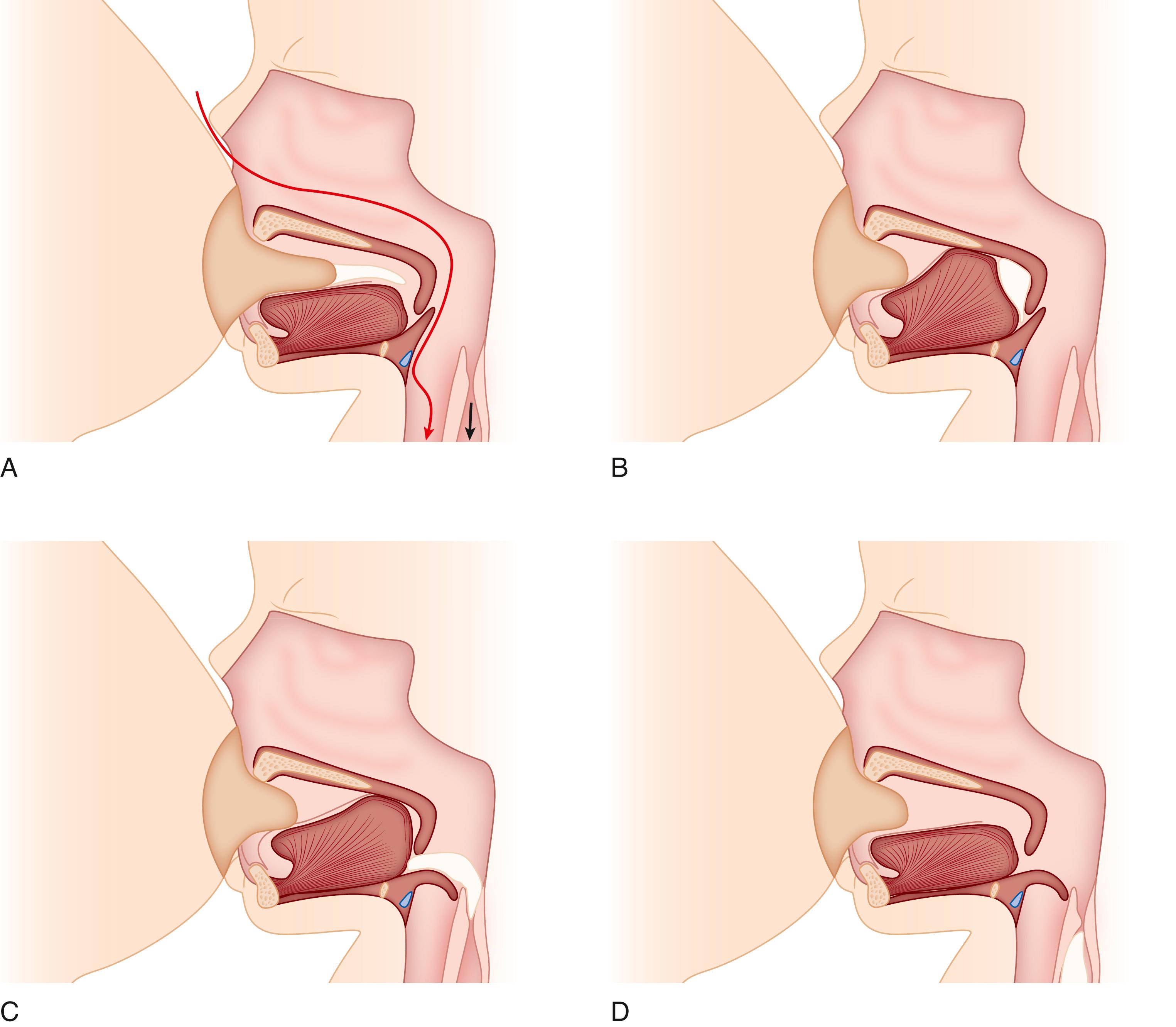 Fig. 84.4, Infant oropharyngeal anatomy: sucking and swallowing. (A) The tongue pulls inferiorly like a piston with the lips sealed over the nipple, creating a negative suction in the oral cavity to draw the nipple and expressed milk in. (B) The tongue presses against the soft palate to seal the milk into a bolus. (C) The bolus depresses the epiglottis and descends through the oropharynx into the upper esophageal sphincter. The tongue and soft palate remain sealed to create negative pressure for the subsequent suck. (D) The bolus proceeds into the upper esophagus as the oral cavity prepares for the next suck.