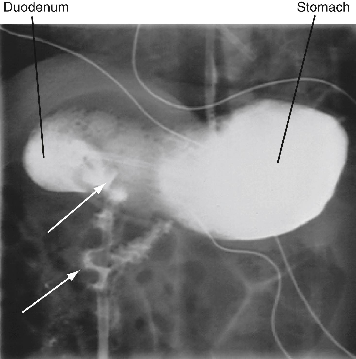 Fig. 14.1, Malrotation of the Gut in a Child