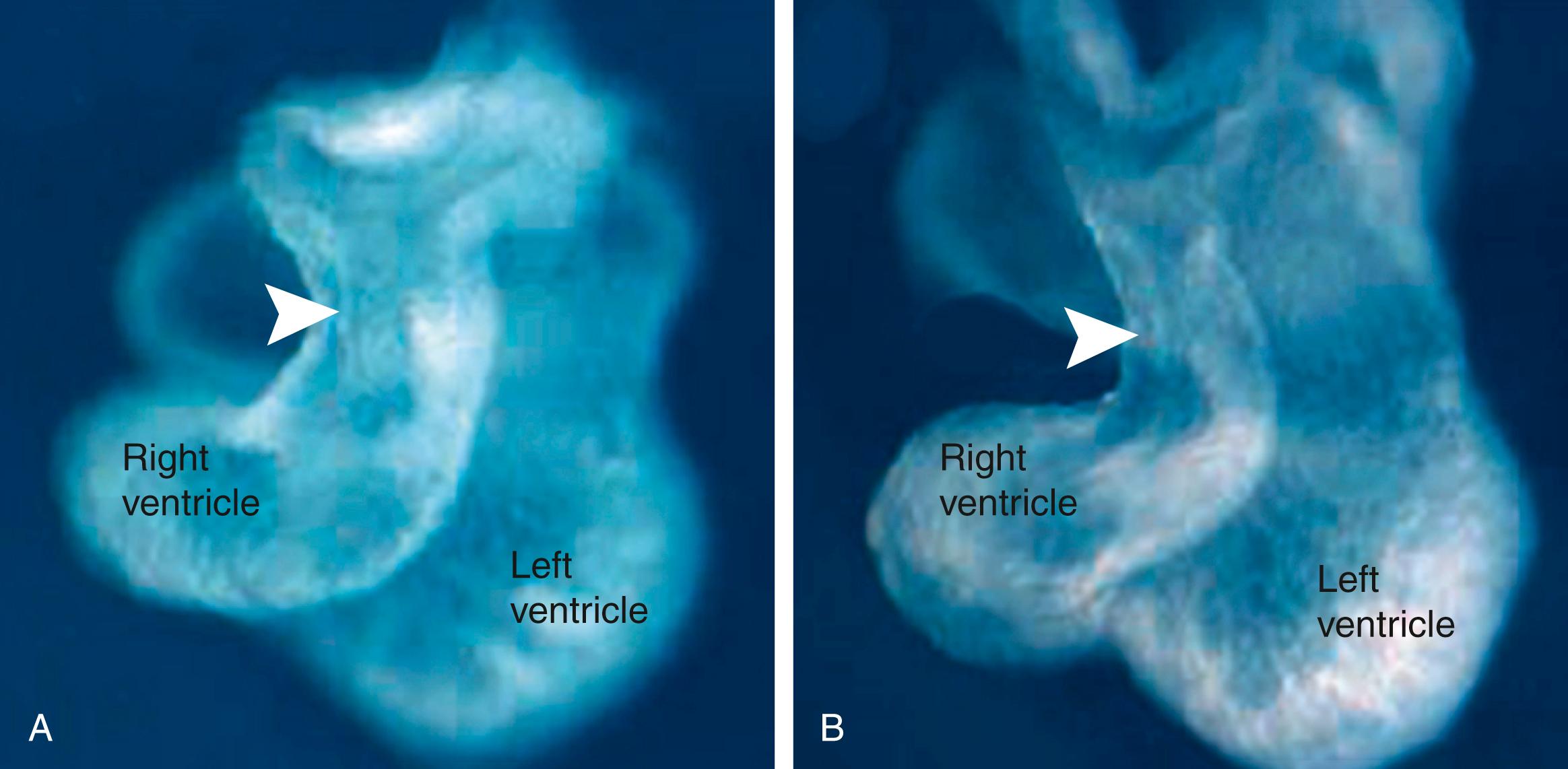 Fig. 12.12, Outflow Tract Development (A) Wildtype mouse embryo. (B) A Tbx1 null embryo. The outflow tract (arrowhead) is shorter and narrower in the absence of Tbx1. (See Figure Credits.)