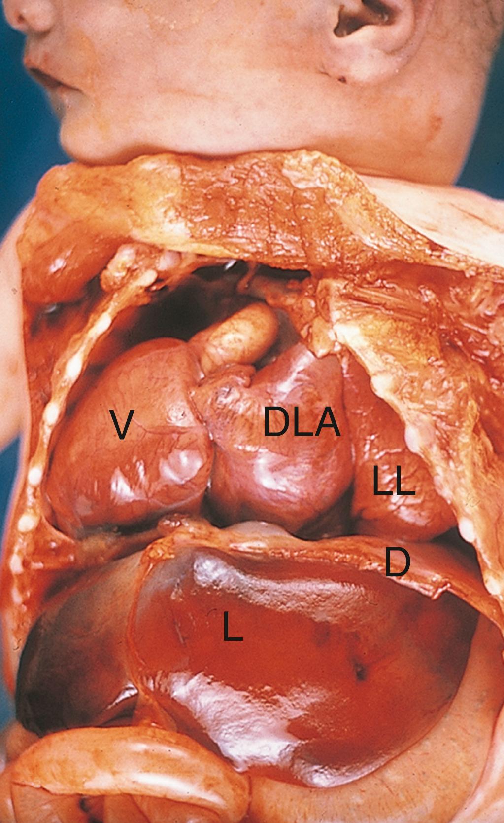 Fig. 12.15, Infant with Ventricular Inversion, a Condition in Which the Looping of the Heart Tube is Reversed From its Normal Sinistral Pattern, Producing a Heart that Has Its Apex Inferior and to the Right (Rather Than Left) Side D, Diaphragm; DLA, dilated left atrium; L, liver; LL, left lung; V, ventricle. (See Figure Credits.)