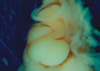 • Fig. 10.2, Looped heart. A dissection of an embryo of approximately 35 days. The pericardial sac has been opened to expose the heart. The heart is looped to the right. The bulboventricular sulcus is seen as a notch on the inferior surface. The inflow is located behind the ventricular mass and the outflow is superior.