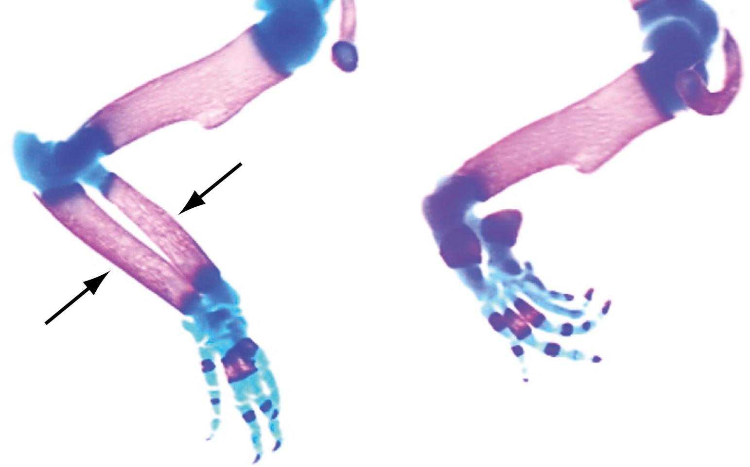 Fig. 20.10, Aplasia of the Radius and Ulna (Zeugopod) Following Gene Inactivation of the Hox11 Paralogs