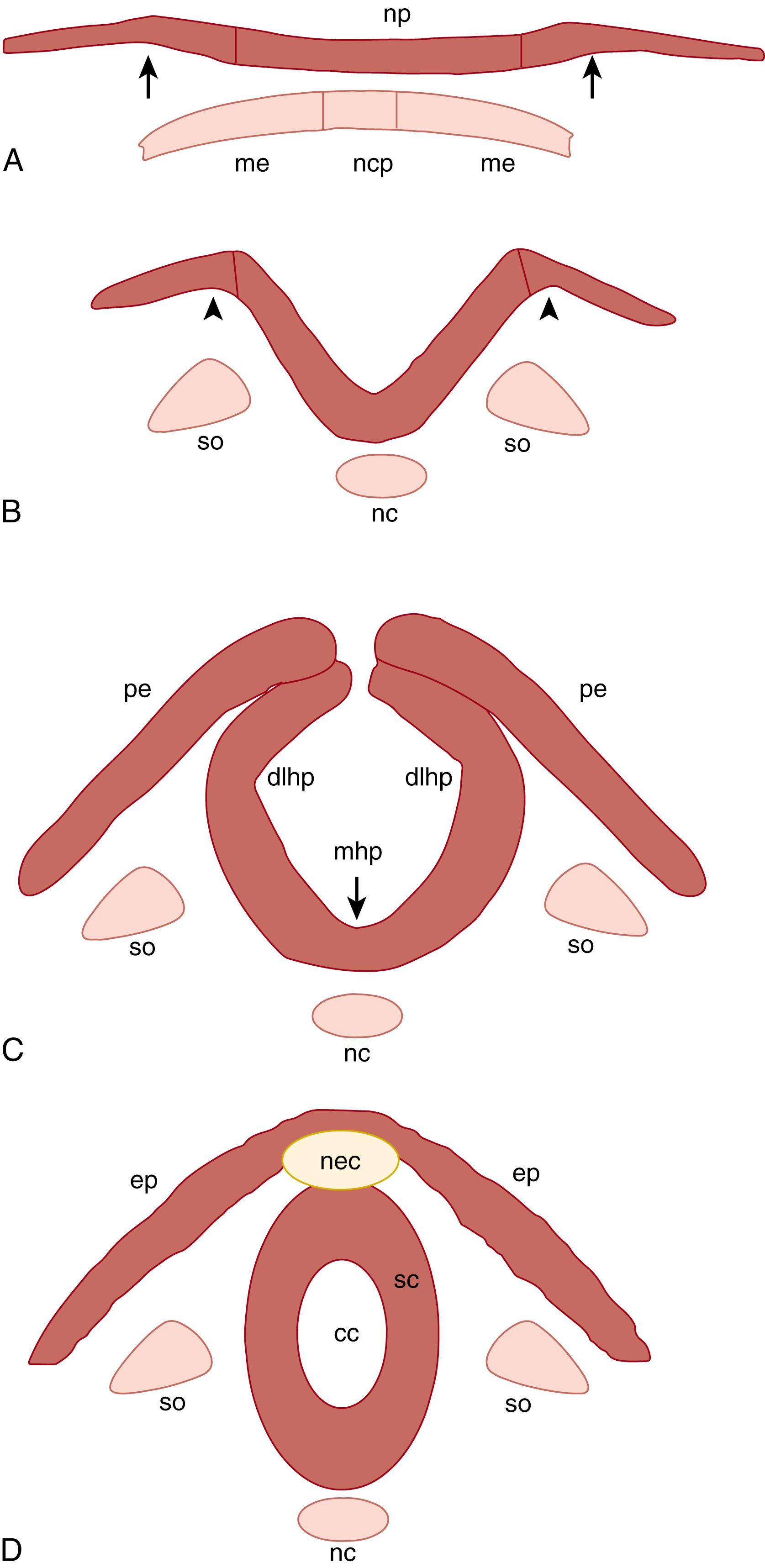 Fig. 124.2, A simplified diagram of neural tube closure. Neural folds form at the lateral extremes of the neural plate (A, arrows ), elevate (B, arrows ) and converge toward the dorsal midline (C), and fuse at their dorsal tips to form the closed neural tube (D). Bending or hinge points form at two sites: the median hinge point (mhp) overlying the notochord and the paired dorsolateral hinge points (dlhp) at the lateral sides of the folds. cc, Central canal; ep, epidermis; me, mesoderm; nc, notochord; ncp, notochordal plate; nec, neural crest; np, neural plate; pe, presumptive epidermis; sc, spinal cord; so, somites.