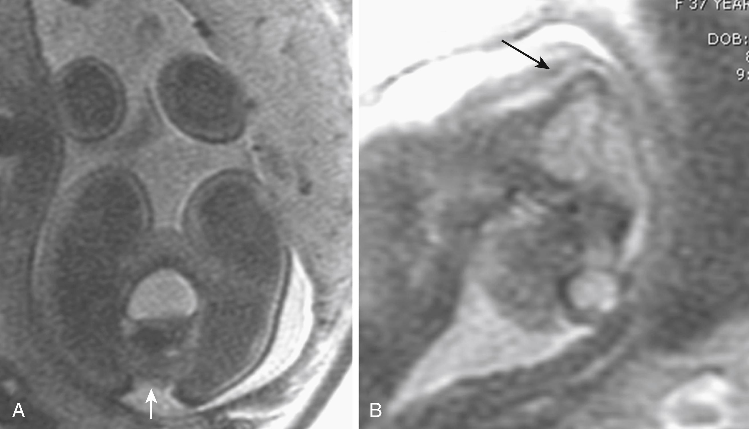 Fig. 124.4, Fetal magnetic resonance imaging at 18 gestational weeks. (A) Occipital encephalocele (arrow). (B) Lumbosacral myelomeningocele (arrow) .