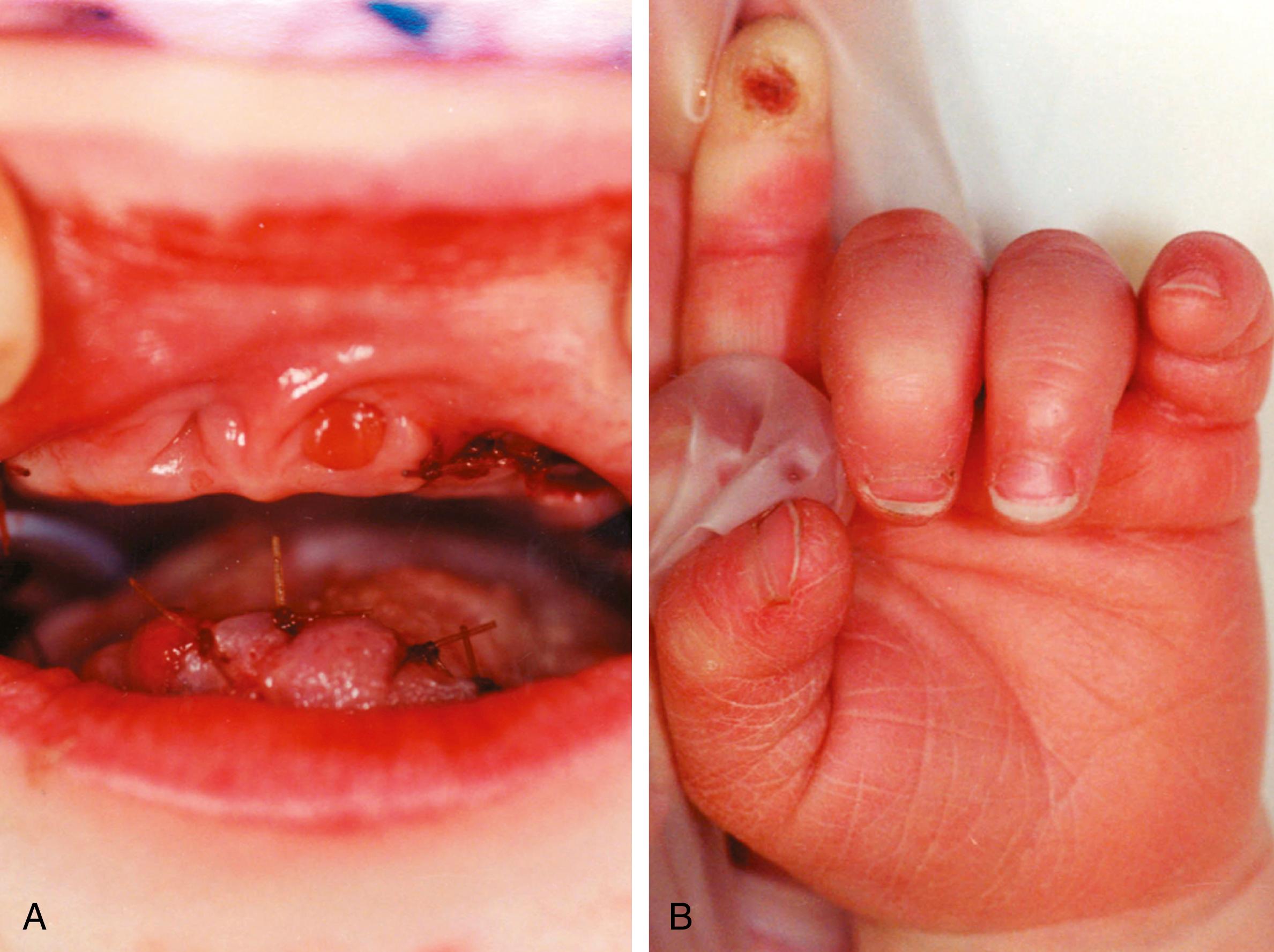 Fig. 10.1, Child With Congenital Insensitivity to Pain With Anhidrosis
