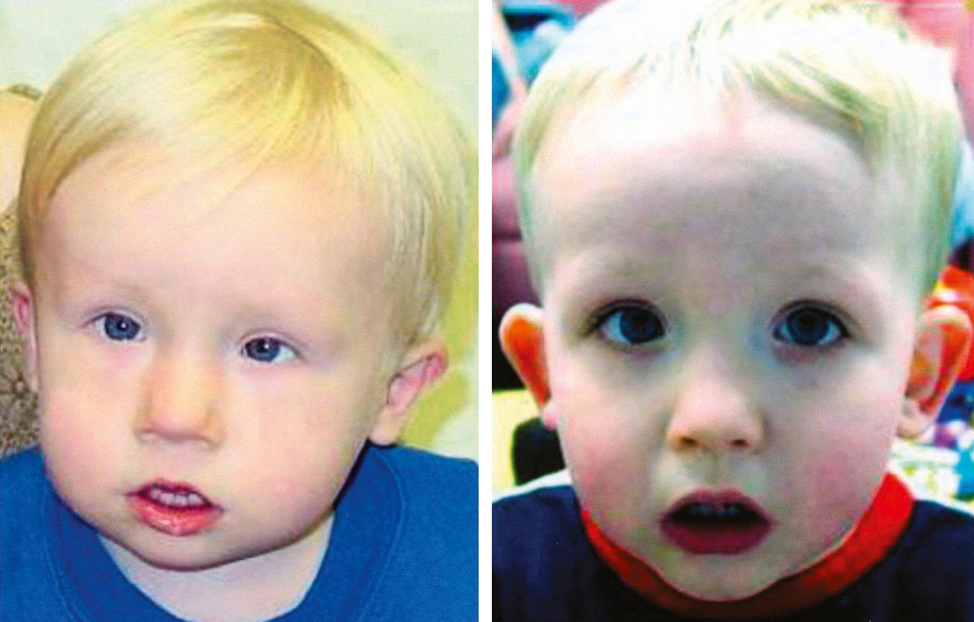 Fig. 17.1, Two Unrelated Children with the Characteristic, But Subtle, Facial Appearance of 22Q11.2 Deletion Syndrome, Including Prominent Nose with Rounded Tip and Hypoplastic Alae Nasi, Reduced Midface, Small Mouth and Chin, Unusually Shaped Ears, and Small Palpebral Fissures (Eye Openings) (See Figure Credits.)