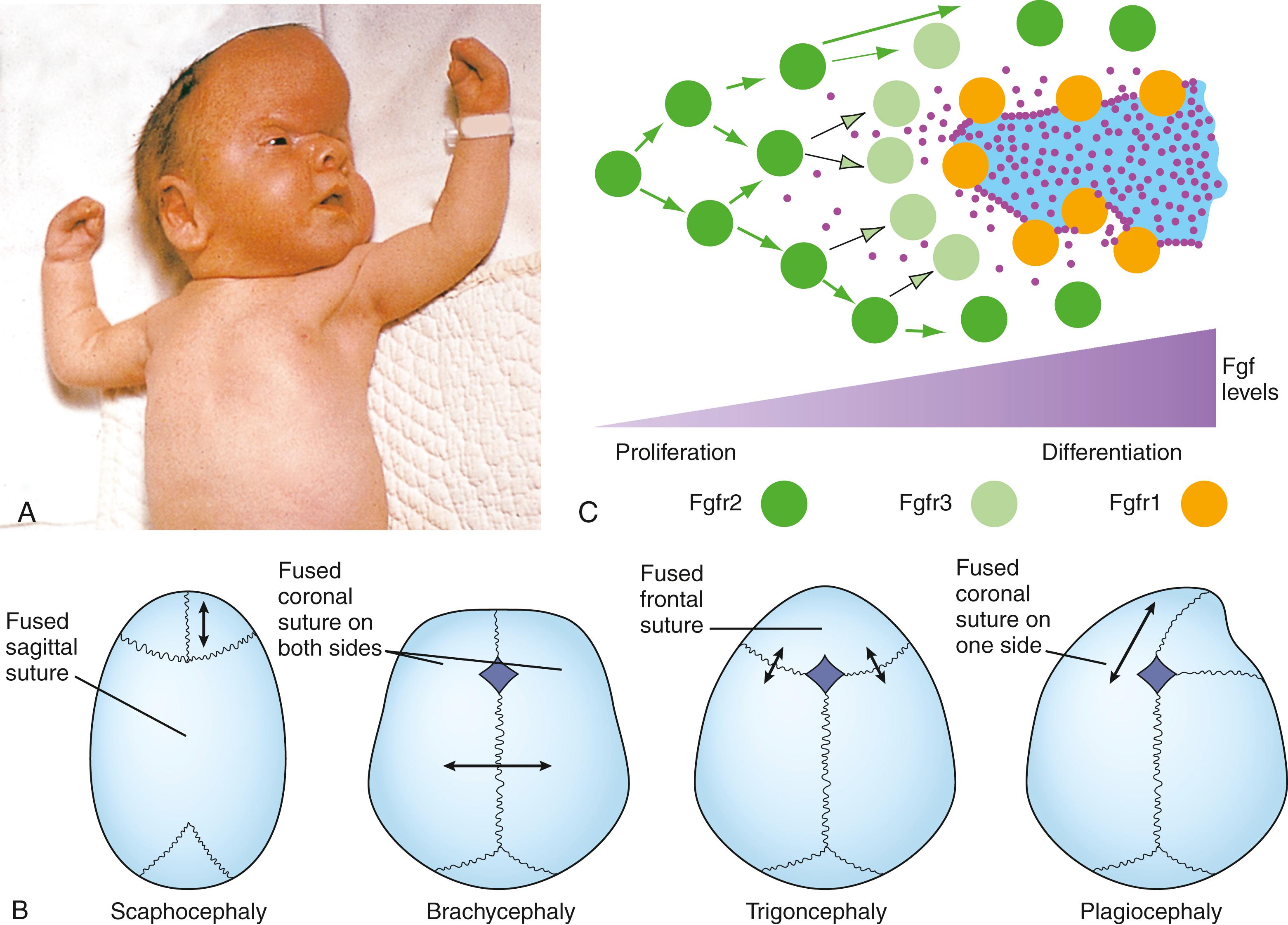 Fig. 17.6, Abnormal Development of the Skull, and Cellular and Molecular Events Underlying Skull Development