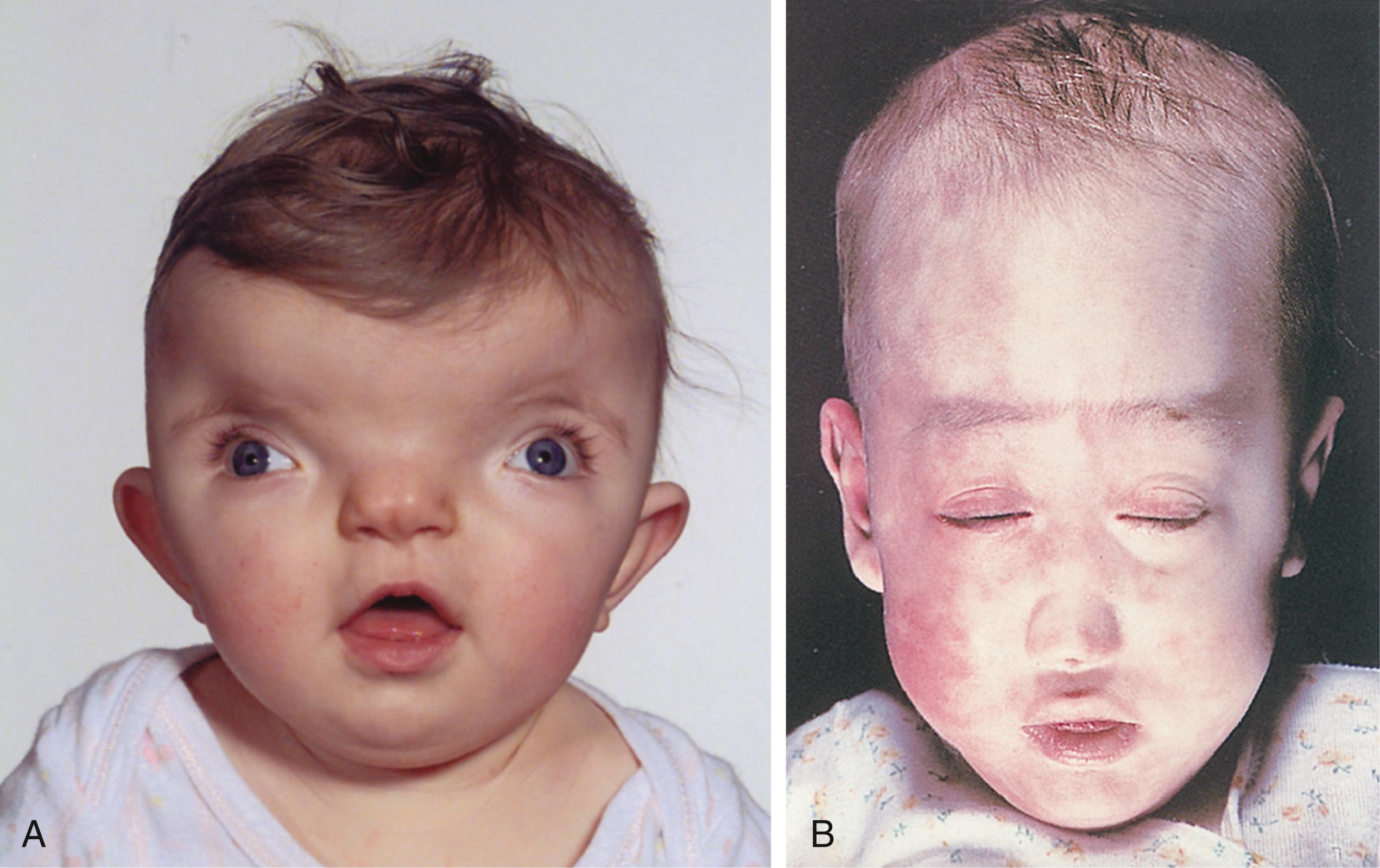 Fig. 17.7, Infants With Two Types of Craniofacial Malformations