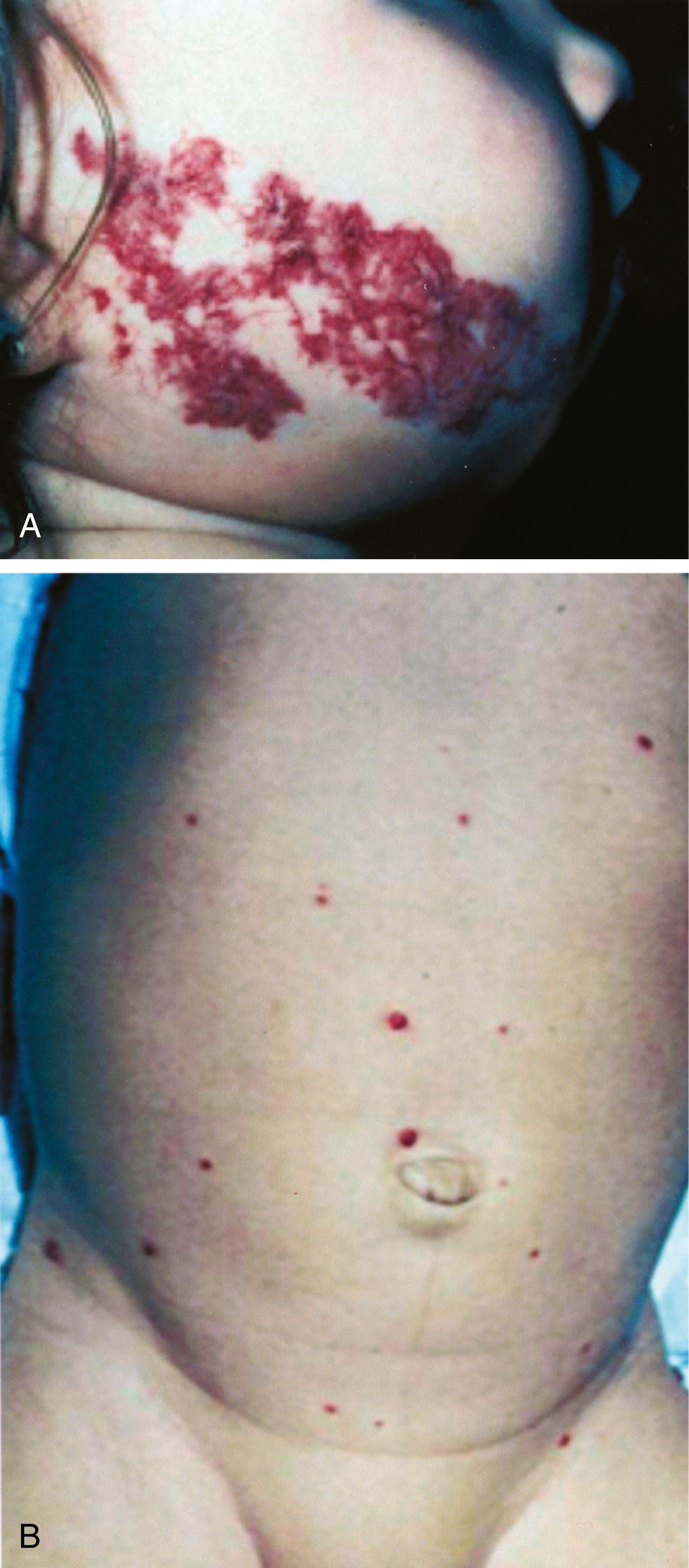 Fig. 13.10, Hemangioma of Human Infancy