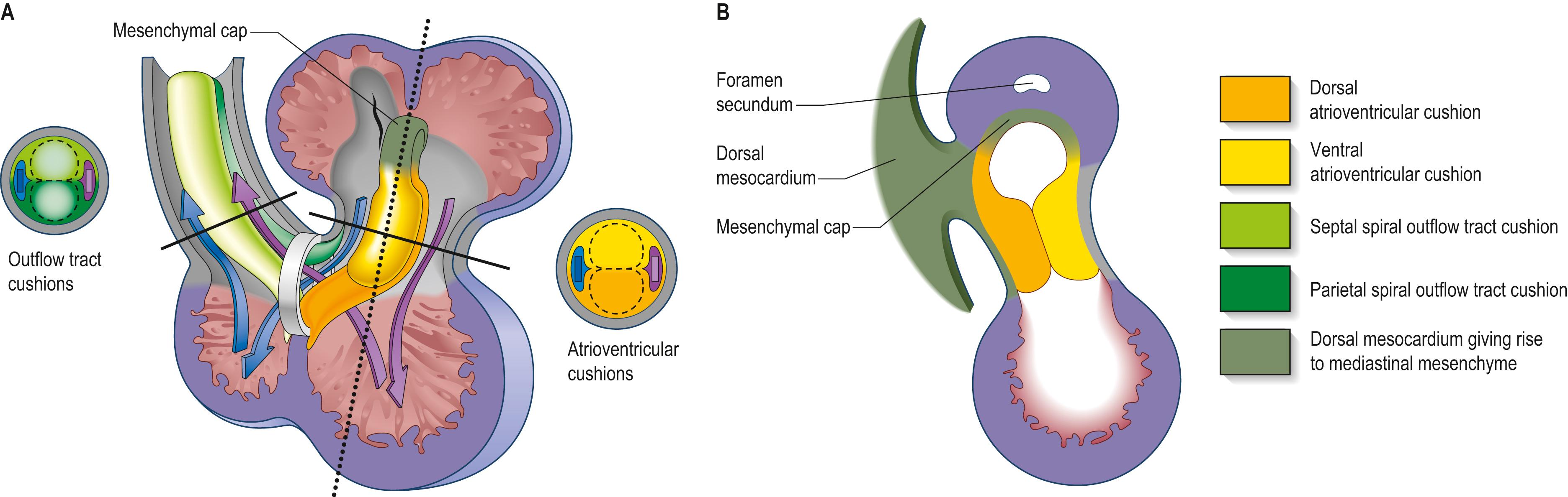 Fig. 13.13, Septation of the ventricles and outflow tract. A , A frontal view of the heart at stage 13, with the outflow tract reflected to the right. Lines show the level of the transverse sections through the atrioventricular cushions and outflow tract. Note that blood from both atria has to pass through the embryonic primary myocardial ring at this stage. B , A sagittal section of heart along the dotted line in A , showing the atrioventricular junctional region as seen from the right side. The atrioventricular cushions extend cranially onto the leading edge of the septum primum where they are fused with the mesenchymal cap.