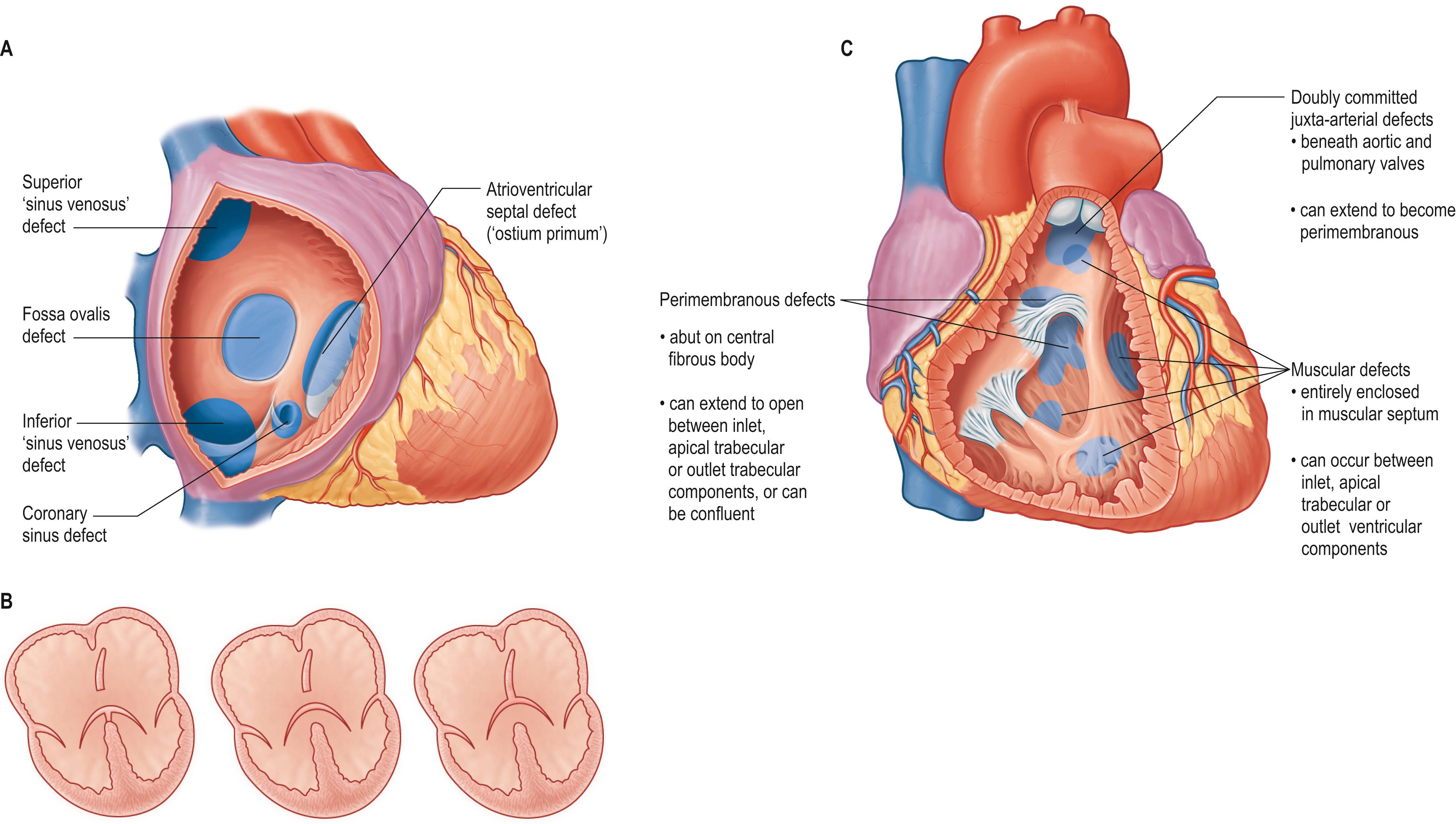 Fig. 13.12, A , Location of the defects that produce an interatrial communication. Only defects within the fossa ovalis are true atrial septal defects. B , Shunting across an atrioventricular septal defect. This can be atrial (left), ventricular (right) or at both levels (middle), depending on the attachment of the bridging cusps. C , Ventricular septal defects. Depending on the structure of the anatomical borders seen from the right ventricle, these defects can be placed into perimembranous, muscular or doubly committed groups.