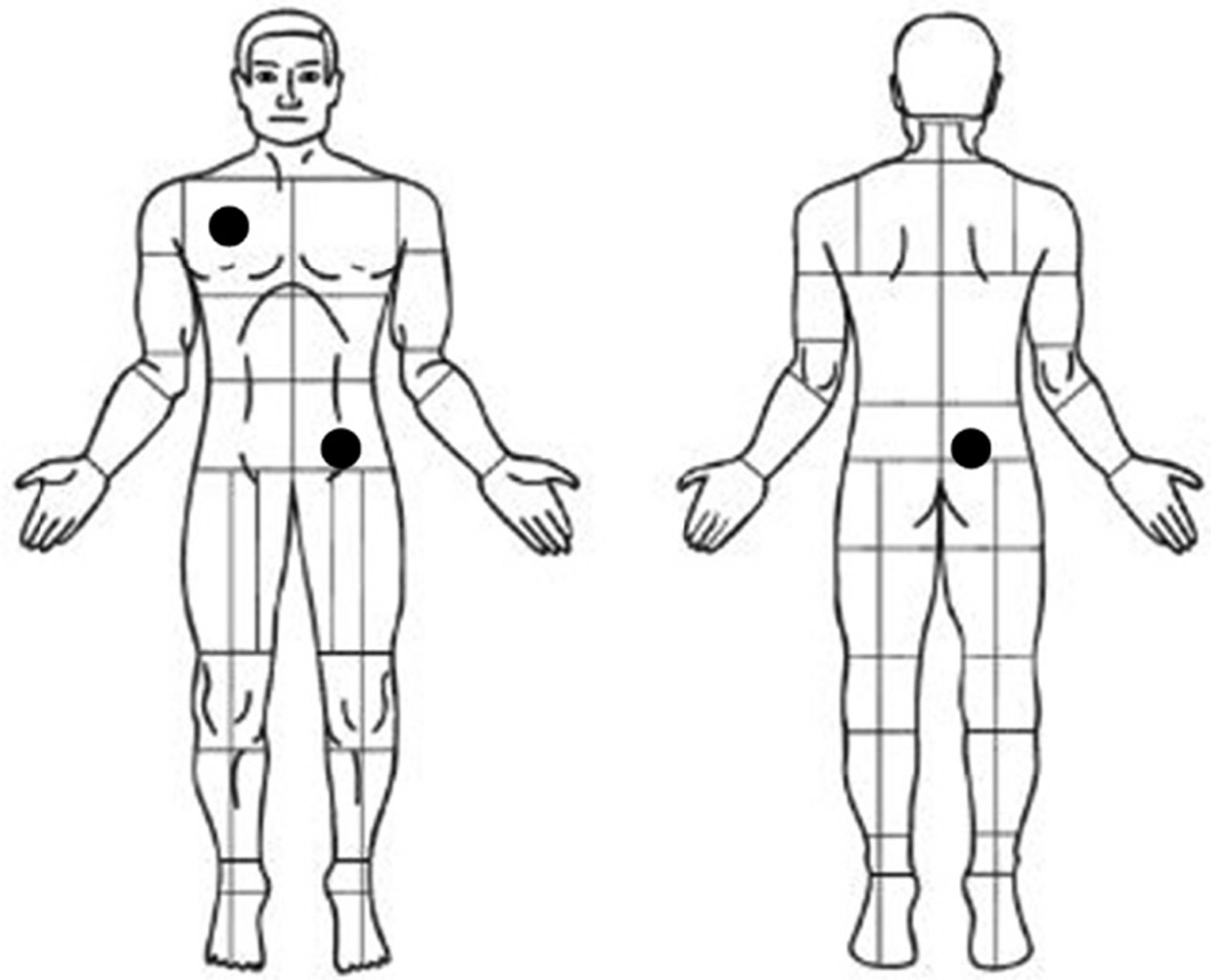 Figure 8.2, Typical device implant locations are indicated by black dots and include the subclavicular region, the lower abdomen, and the upper buttocks.