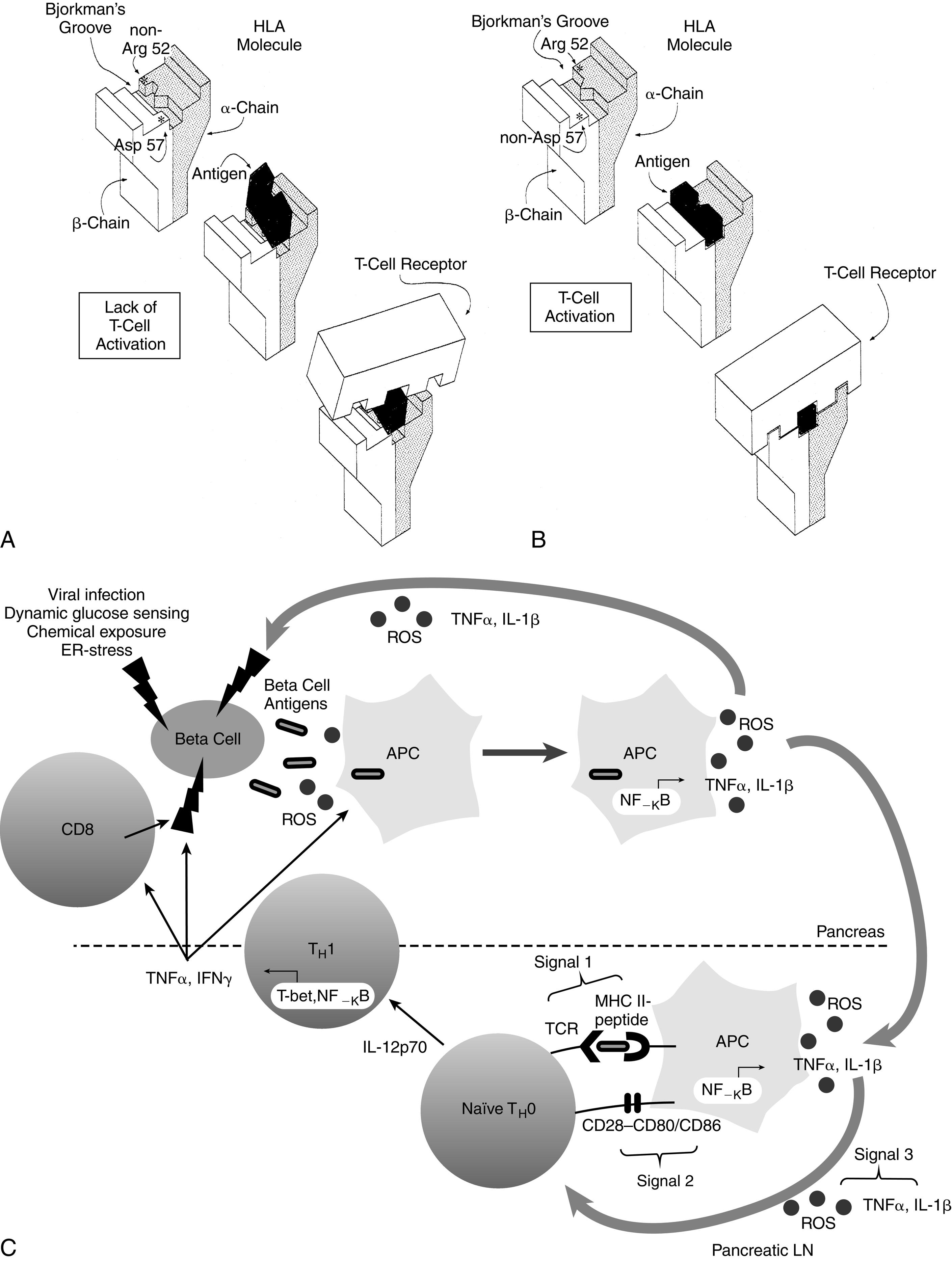 Fig. 21.4, Representation of the interaction between antigen presentation in the context of specific human leukocyte antigen ( HLA )-DQ subtypes and the T-cell receptor. A, Presence of aspartic acid at position 57 of the DQ b chain and an amino acid other than arginine at position 52 of the a chain prevents antigen lodging in the Bjorkman groove. Therefore antigen presentation to the T-cell receptor is impaired—and in the absence of this “fit,” T-cell activation is prevented. B, Lack of aspartic acid at position 57 of the DQ b chain and arginine at position 52 of the DQ a chain permits antigen to fit and be recognized by the T-cell receptor that is now activated. C, Role of redox in the immunopathology of type 1 diabetes. An initial genetic or environmental insult to the beta cell triggers the release of beta-cell antigens, as well as the production of reactive oxygen species ( ROS ). Beta-cell antigens are phagocytosed, and ROS are able to stimulate redox-dependent transcription factors, such as nuclear factor (NF)-κB, which leads to antigen presenting cell ( APC ) activation and cytokine secretion. ROS and proinflammatory cytokines secreted by APCs act as the third signal within the T-cell–APC immunological synapse, which occurs in the pancreatic lymph node. ROS play a critical role in the progression of naïve TH0 cells to cytokine-secreting TH1 cells. Release of interferon (IFN)γ by TH1 cells then works directly on the beta cells, as well as activating more APCs and CD8 cells, all of which can impart deleterious effects on the islets.