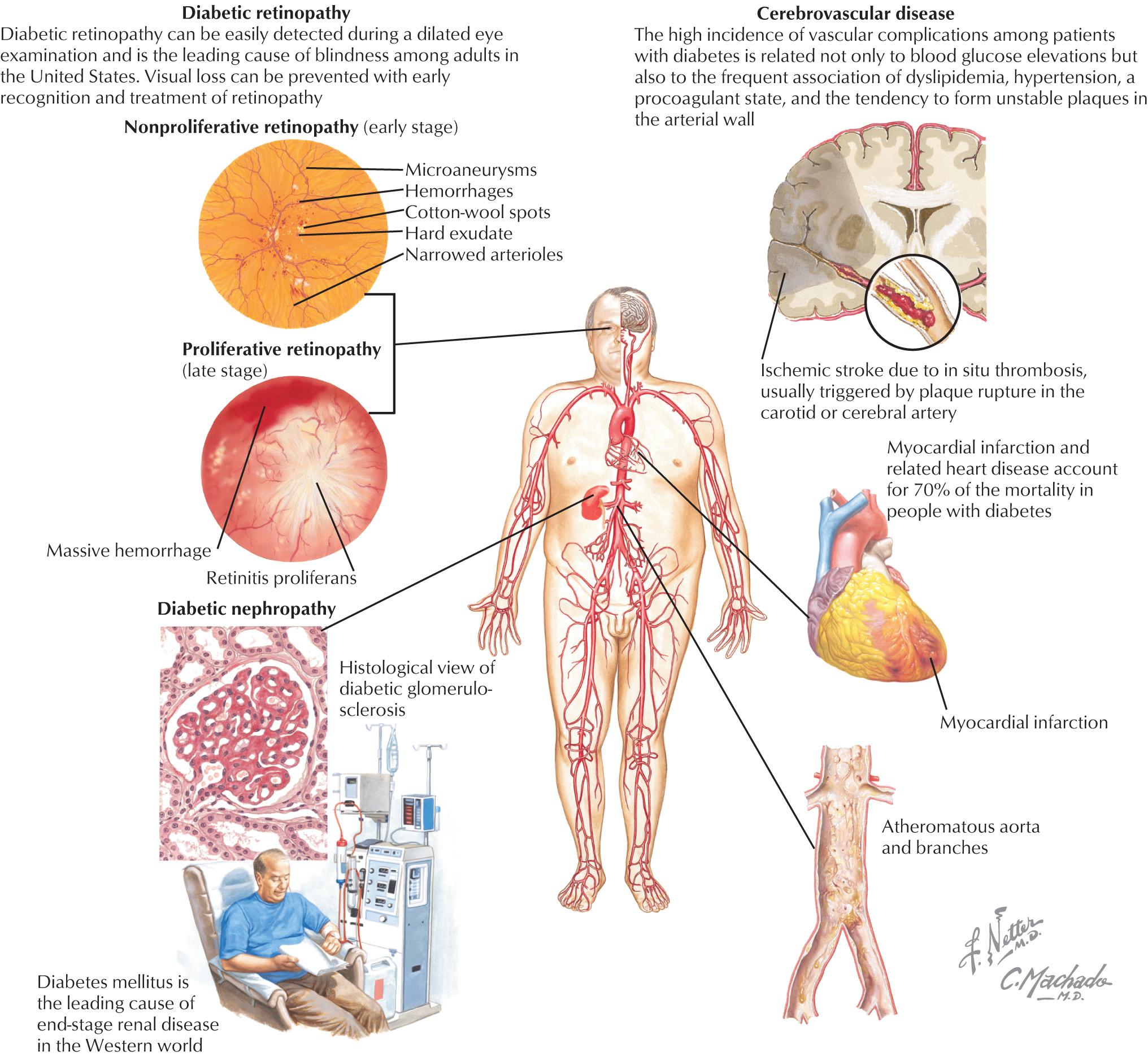 FIG 17.1, Diabetes mellitus and its complications: microvascular and macrovascular complications.