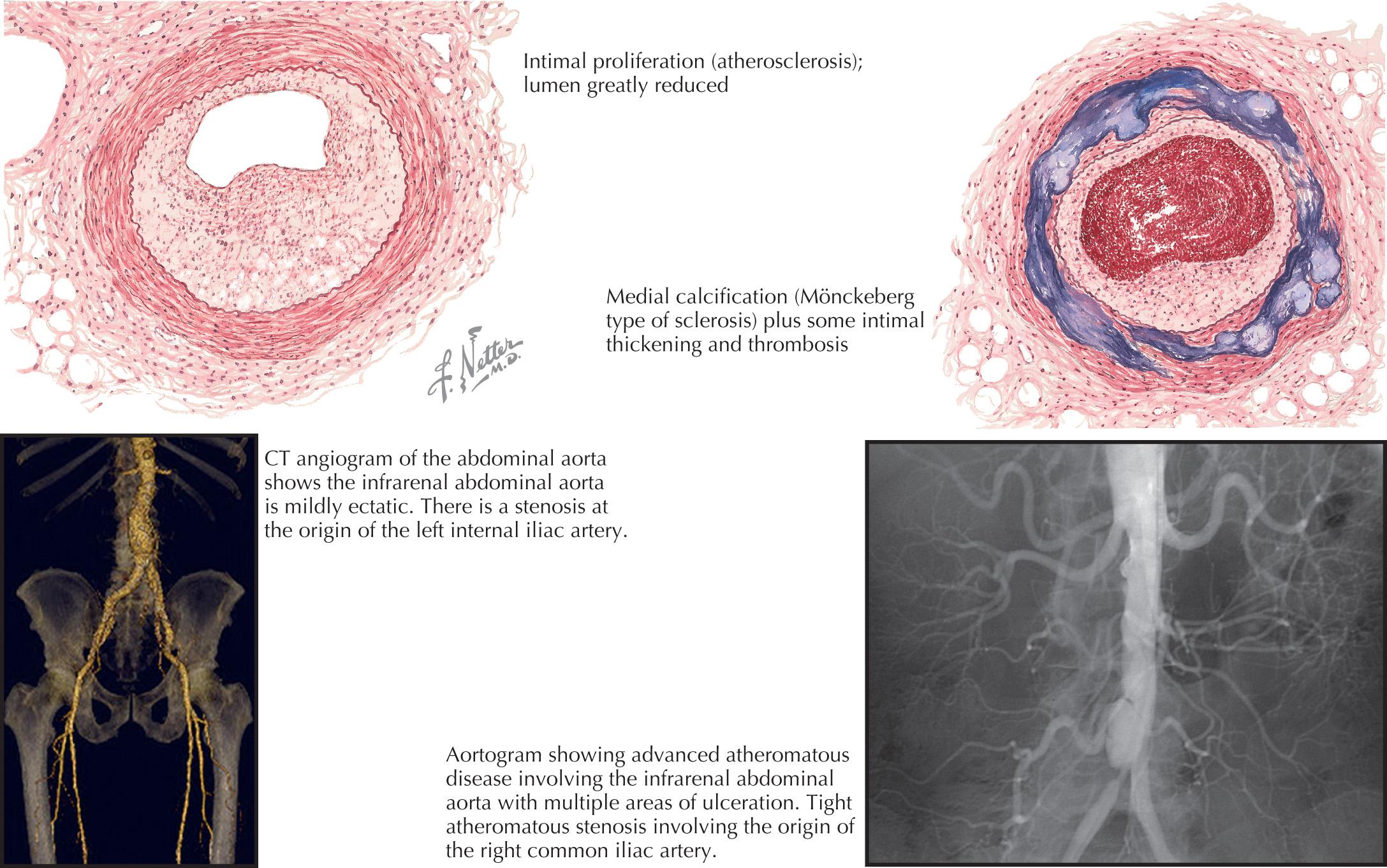 FIG 17.2, Atherosclerosis in diabetes.