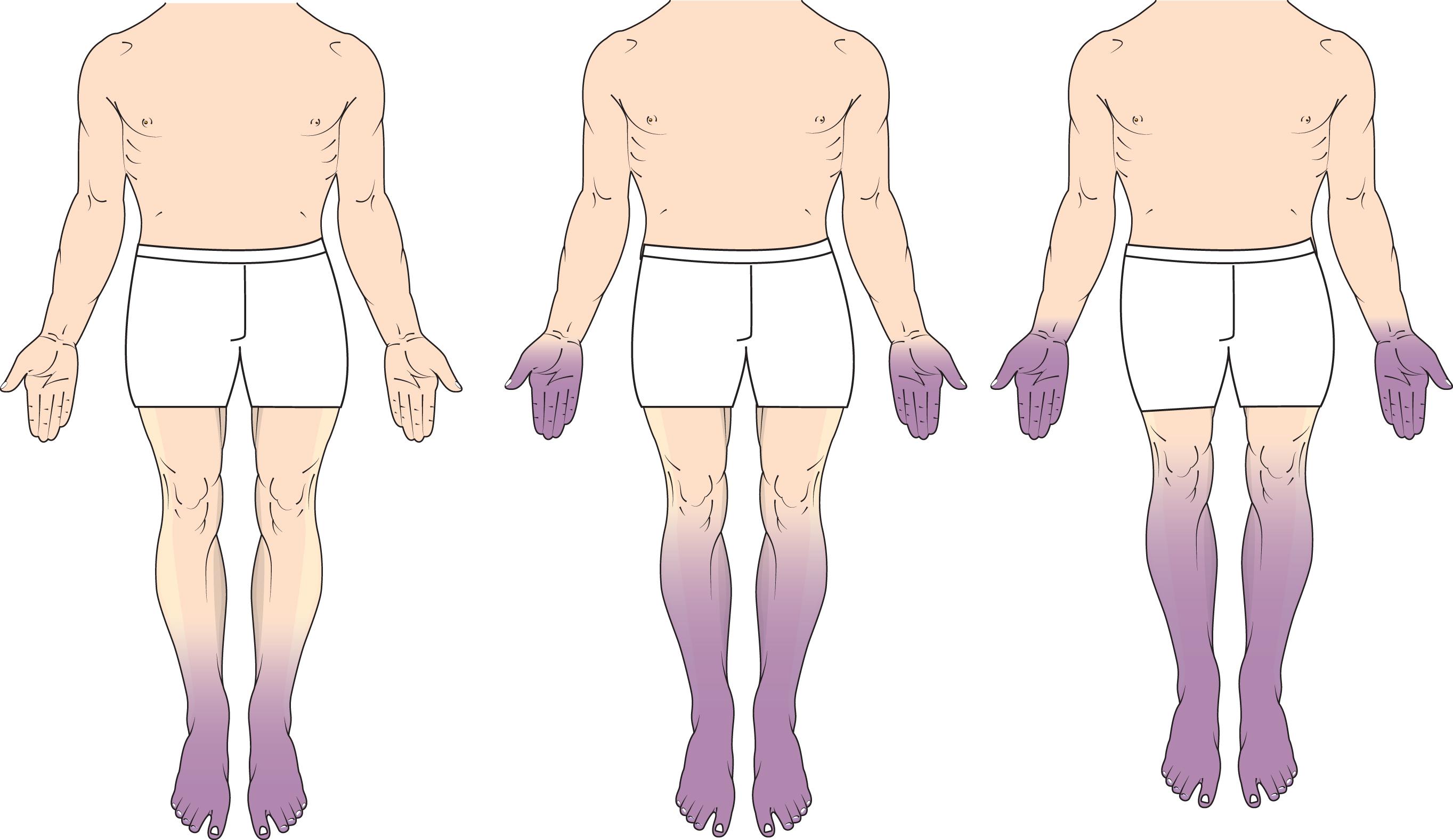 Figure 19-1, Illustration of progressive stocking-and-glove sensory changes in a patient with progressive diabetic polyneuropathy. Sensory symptoms and signs begin in the distal territories of sensory nerves in the toes and fingers, with a gradual spread proximally.