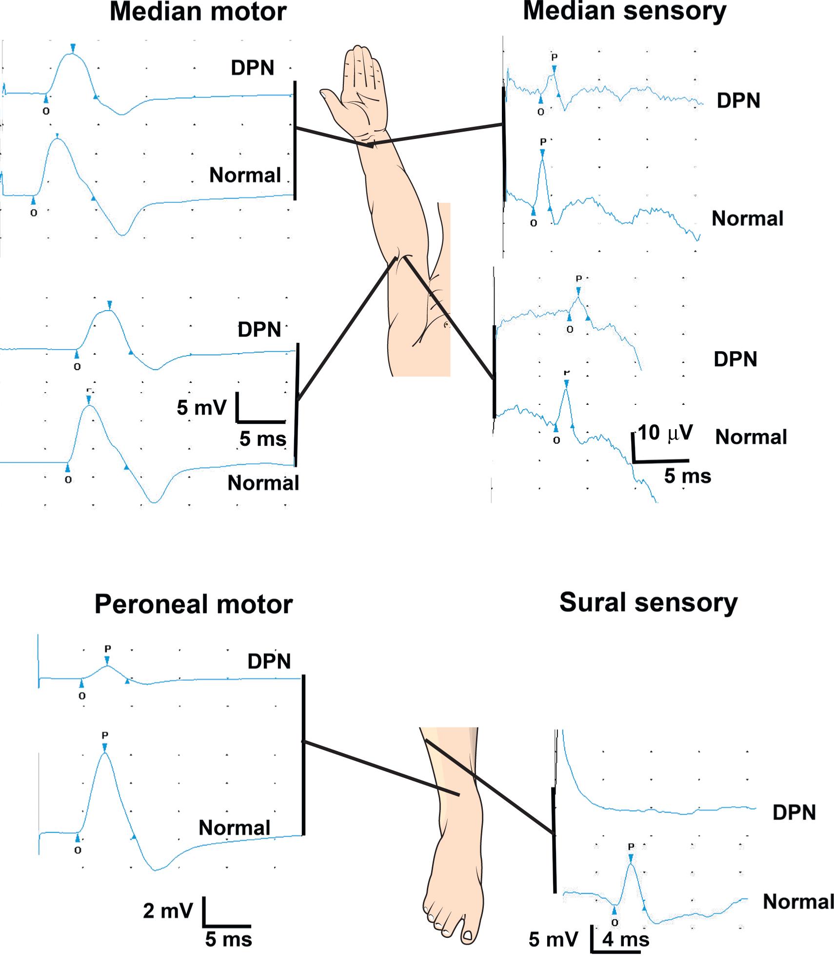 Figure 19-2, Examples of nerve conduction abnormalities in a patient with moderately severe diabetic polyneuropathy (DPN) compared with waveforms in a normal subject. Note the decreased amplitude and prolonged latency of compound muscle action potentials and sensory nerve action potentials. The sural sensory nerve action potential is absent. Lines indicate nerve stimulation sites (recording site for the median motor nerve is the abductor pollicis brevis; for the median sensory nerve, the index finger; for the fibular [peroneal] motor nerve, the extensor digitorum brevis; and for the sural nerve, behind the lateral ankle).