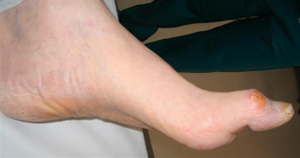 Figure 117.2, Intrinsic minus foot with muscle wasting.