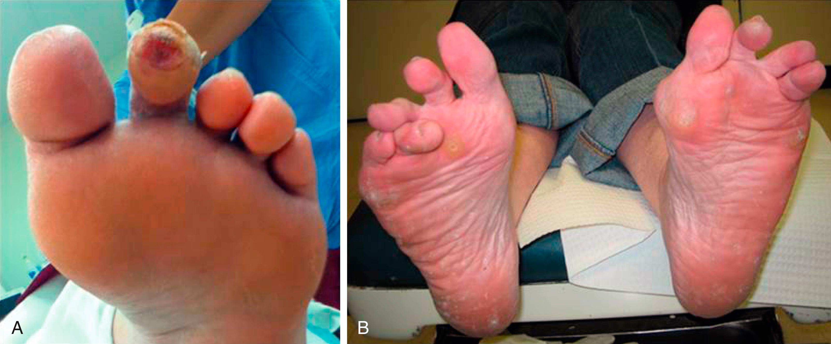 Figure 117.3, ( A ) Hammertoe with ulcer on the weightbearing surface of the distal toe. ( B ) Multiple digital deformities.