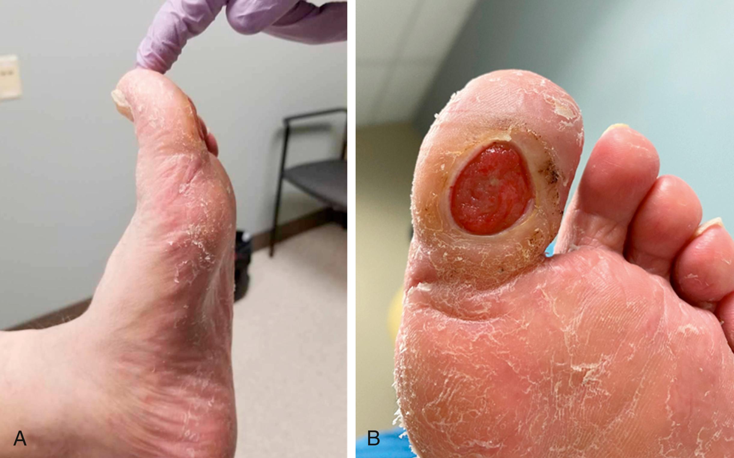 Figure 117.4, ( A ) Decreased dorsiflexion of the metatarsophalangeal joint. ( B ) Resultant ulcer on the plantar aspect of the hallux interphalangeal joint.