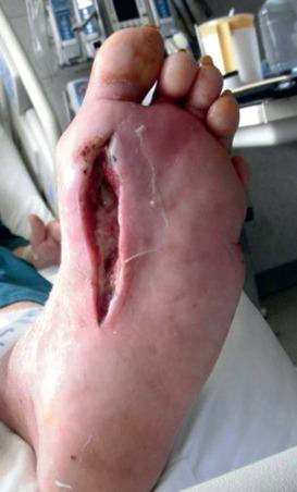 FIG 62.1, A longitudinal incision on the plantar aspect of the forefoot to drain an abscess tracking through the medial compartment of the foot.