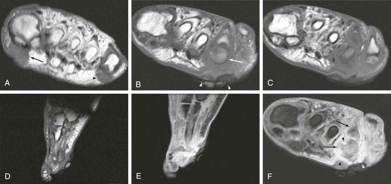 FIGURE 67–1, Callus and ulceration. A, T1-weighted short-axis MR image shows typical location of callus formation, under the first (arrow) and fifth (arrowhead) metatarsal heads. B, C, and D, T1-weighted MR images show ulcerated callus (arrowheads) with typical heaped-up edges. Replacement of marrow fat in the underlying metatarsal head (arrow) represents osteomyelitis occurring due to contiguous spread. E and F, Short-axis and sagittal, contrast-enhanced, fat-suppressed, T1-weighted MR images show enhancement at the base of the ulcer (white arrowheads) . There is enhancement of the underlying soft tissues representing cellulitis. There is also enhancement of the metatarsal head and phalanx (arrows) , indicating osteomyelitis. Erosion at the metatarsophalangeal joint (black arrowhead) represents septic arthritis.