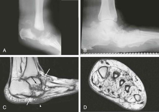 eFIGURE 67–1, Effects of neuropathic disease in the diabetic foot. A , Total destruction of the ankle and hindfoot in a patient with mixed atrophic and hypertrophic form of neuropathic osteoarthropathy. In the acute phase, this often simulates infection clinically and on imaging examinations. B , Lateral radiograph of the ankle shows chronic hypertrophic neuropathic osteoarthropathy of the midfoot and hindfoot with collapse of the arch and rocker-bottom deformity. C , Sagittal T1-weighted MR image demonstrates deformity of the midfoot and hindfoot, with collapse, subluxation, and disorganization of the tarsal bones (arrows) and bone proliferation, characteristic of chronic neuropathic disease. There is rocker-bottom deformity; skin thickening and subcutaneous low signal (arrowhead) beneath the cuboid represent callus formation. D , Muscle atrophy. T1-weighted, short-axis MR image through the metatarsal bones shows fatty atrophy of the intrinsic foot muscles in a patient with long-standing diabetes mellitus.