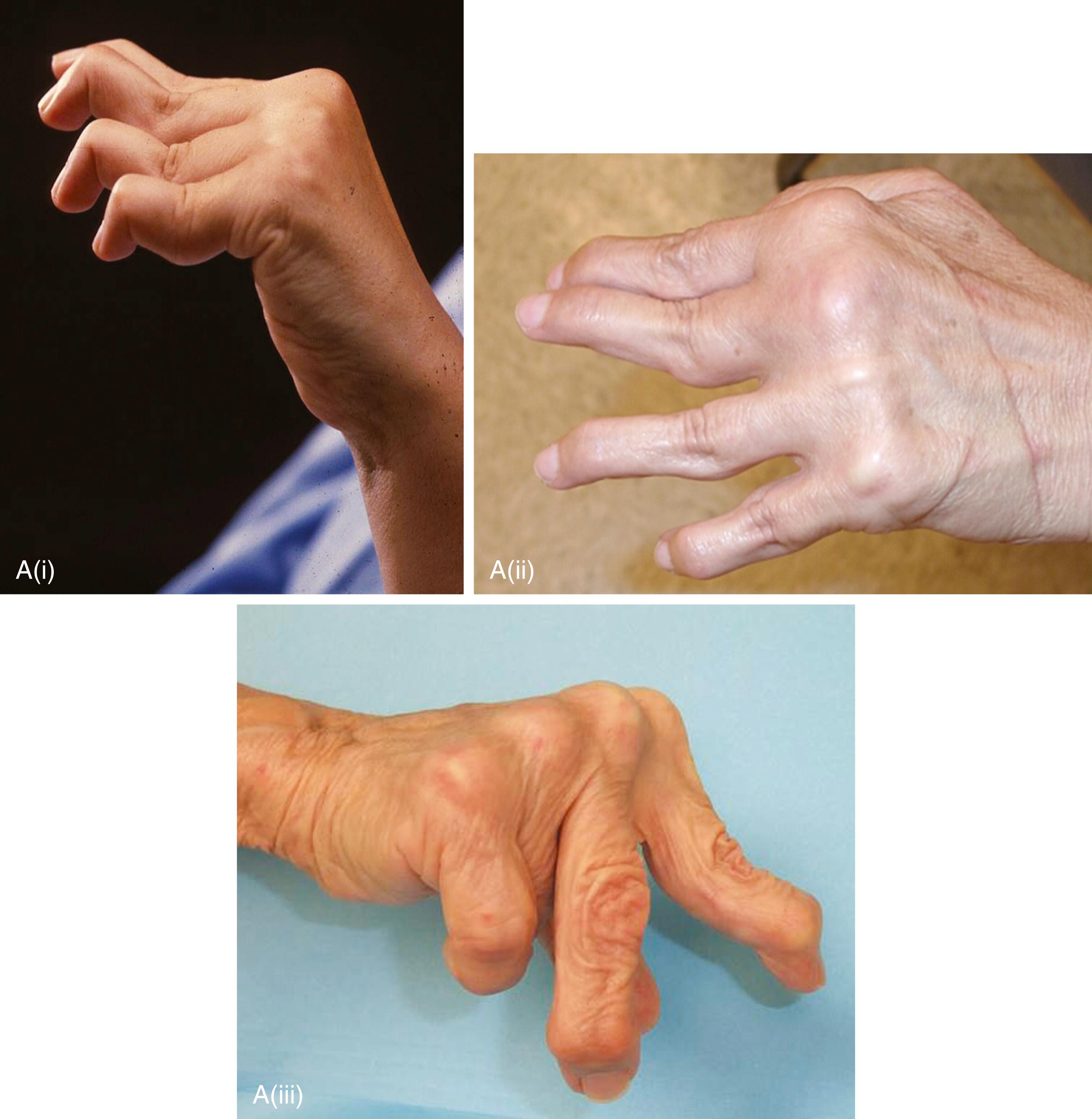 Fig. 24.2, Parkinsonian Deformities.