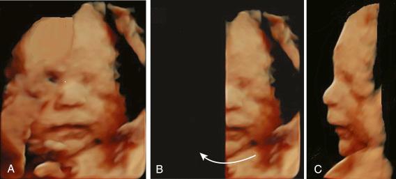 • Fig. 35.11, Three-dimensional rendered frontal view of the face with high definition technique ( A ). Half of the picture is deleted with the electronic scalpel ( B ). After turning the head around the y-axis of the fetus, the profile is visible against a clear black background ( C ).