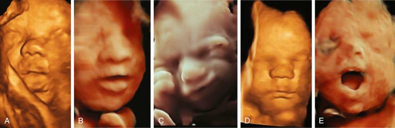 • Fig. 35.12, A–E, Three-dimensional rendered ultrasound pictures in several settings showing various facial expressions.