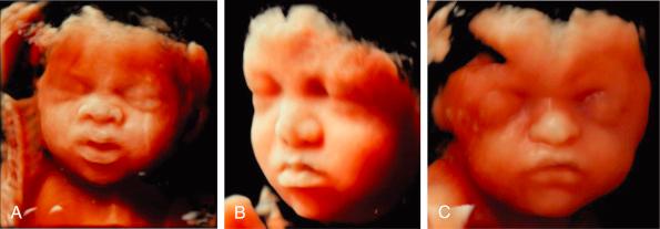 • Fig. 35.13, Surface-rendered images of syndromic fetuses, trisomy 21 ( A ), Binder syndrome ( B ) and Apert syndrome ( C ). (Courtesy Dr B. Benoit)