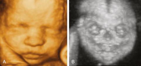 • Fig. 35.14, Examples of three-dimensional rendered ultrasound pictures of a normal face using surface ( A ) and maximum ( B ) mode.